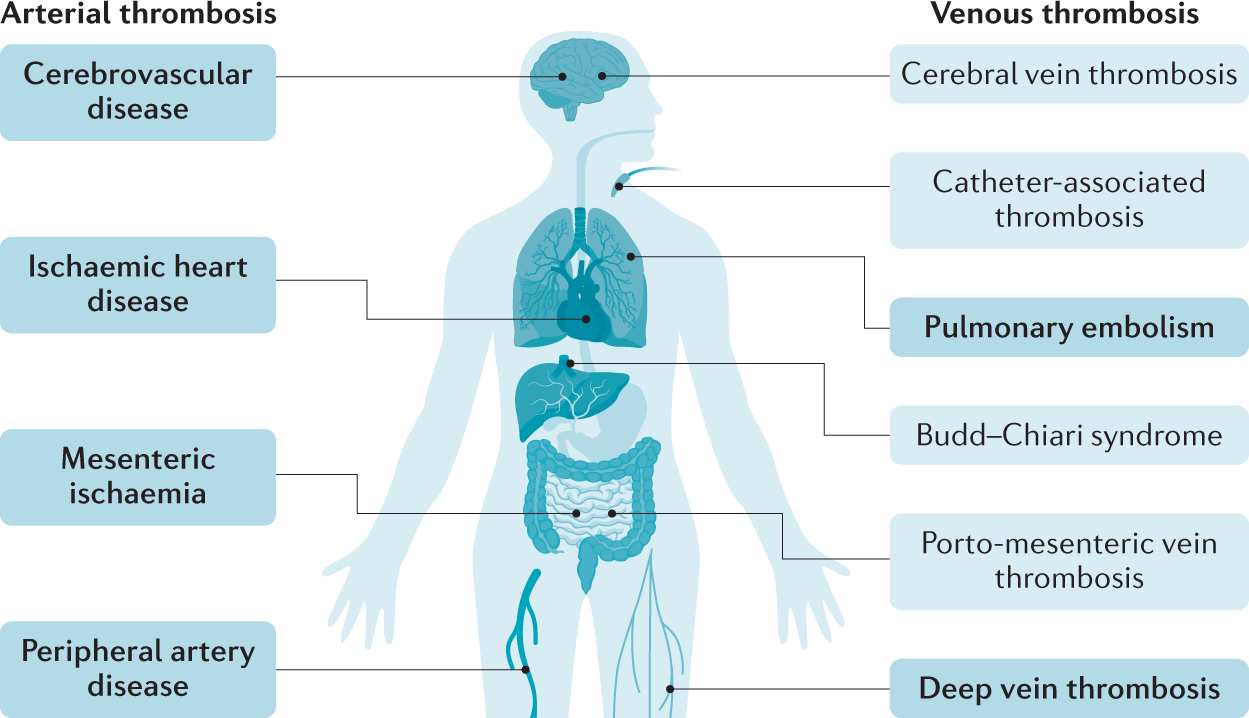 Inherited Thrombophilia and the Risk of Arterial Ischemic Stroke