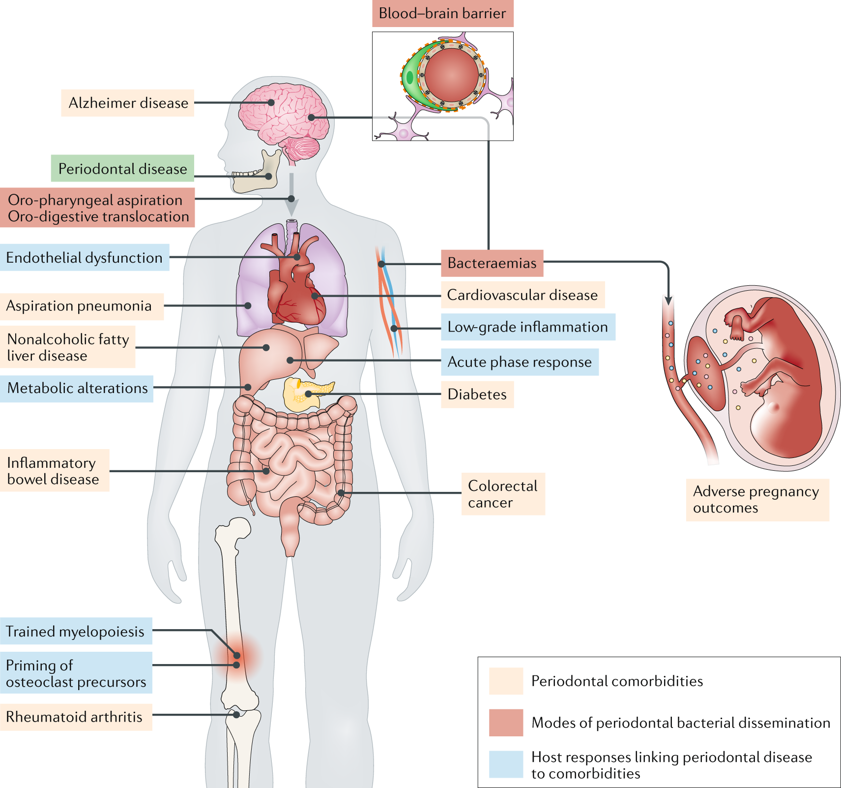 A somatization comorbidity phenotype impacts response to therapy