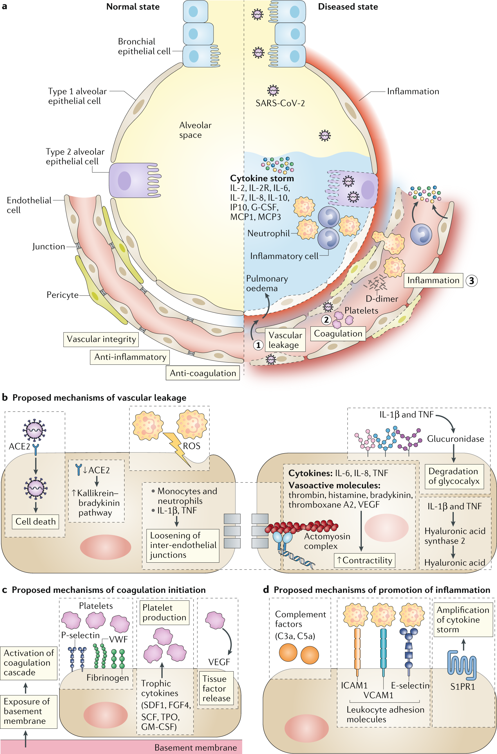 Endothelial cell infection and endotheliitis in COVID-19 - The Lancet