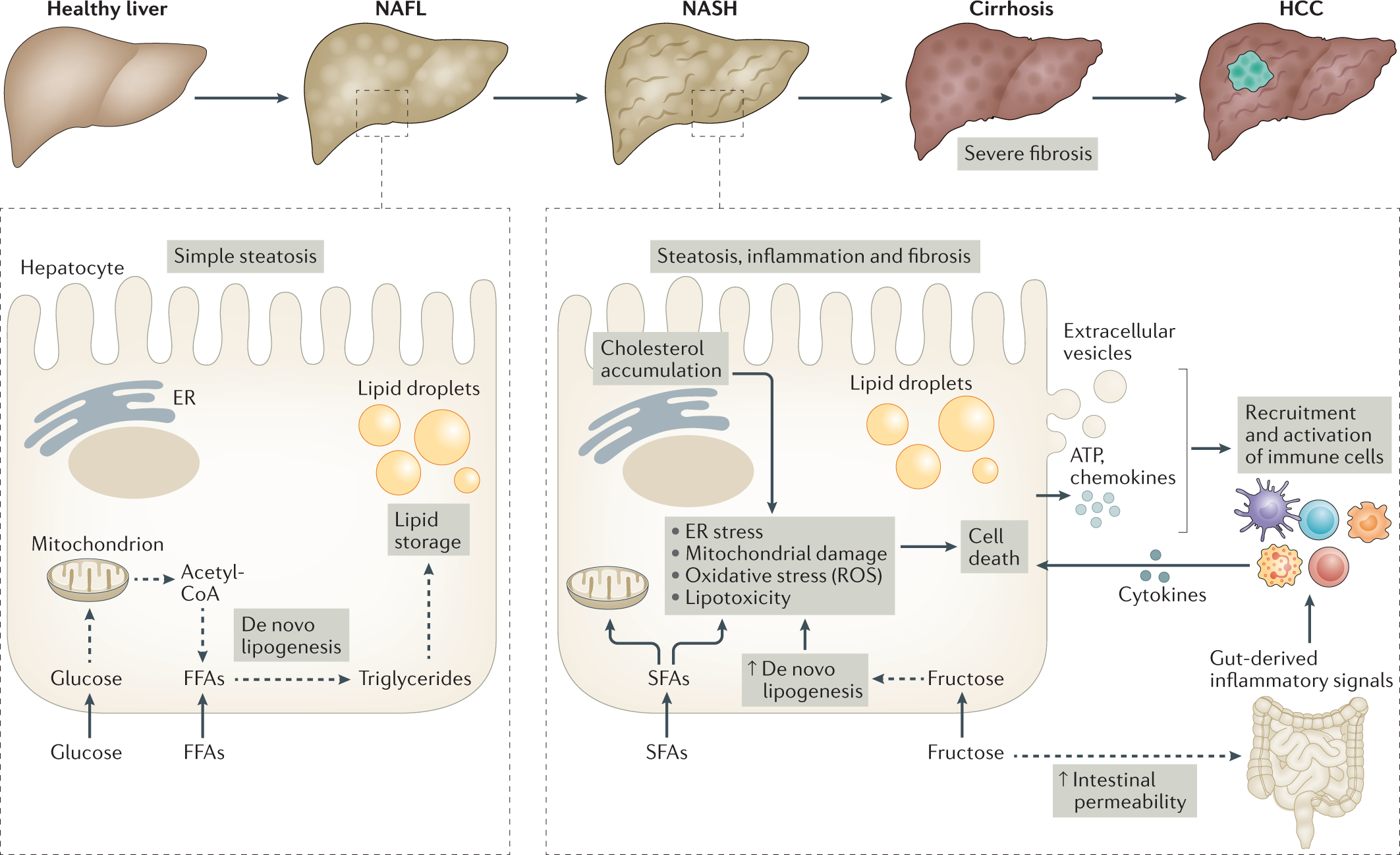 Immune cell-mediated features of non-alcoholic steatohepatitis | Nature  Reviews Immunology
