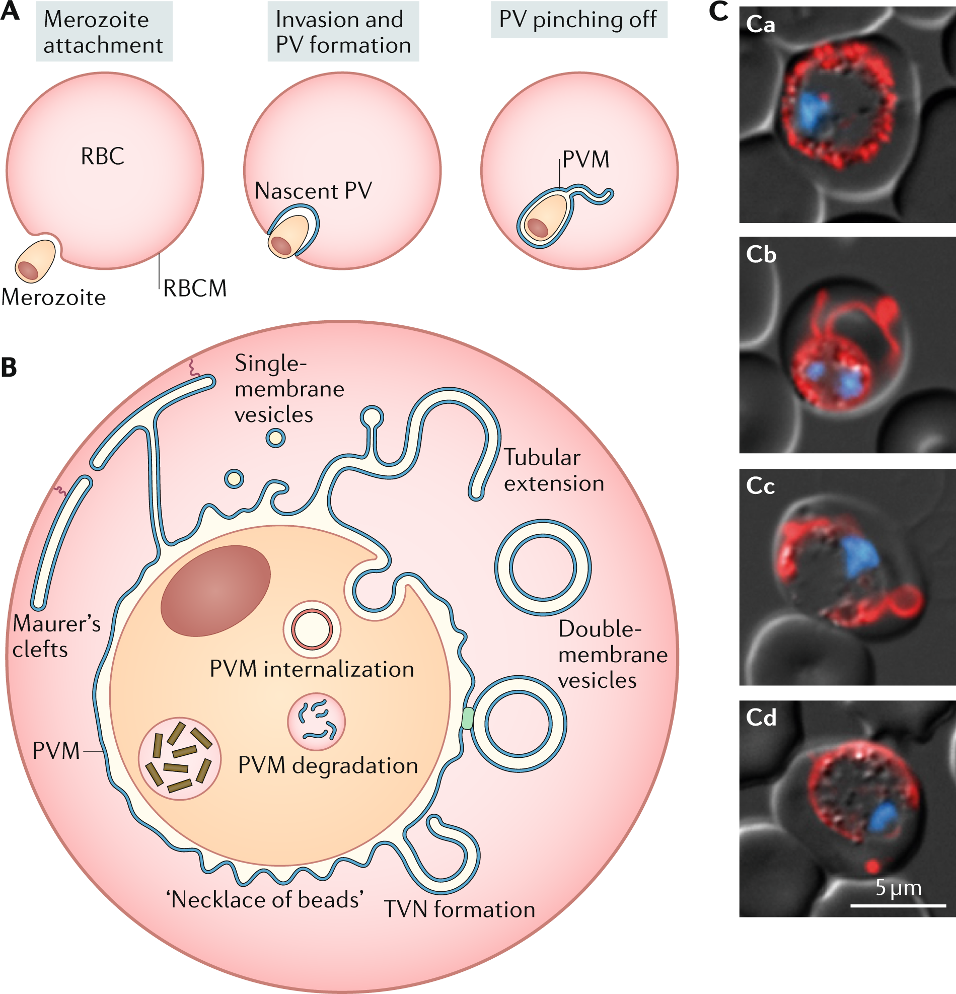 Cureus | Let's Not Miss the Treatable Ones: Two Cases of Neonatal Sepsis  Due to Malaria | Article