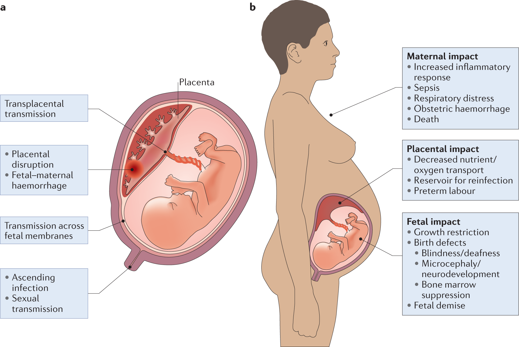 Infections at the maternal–fetal interface: an overview of pathogenesis and  defence | Nature Reviews Microbiology