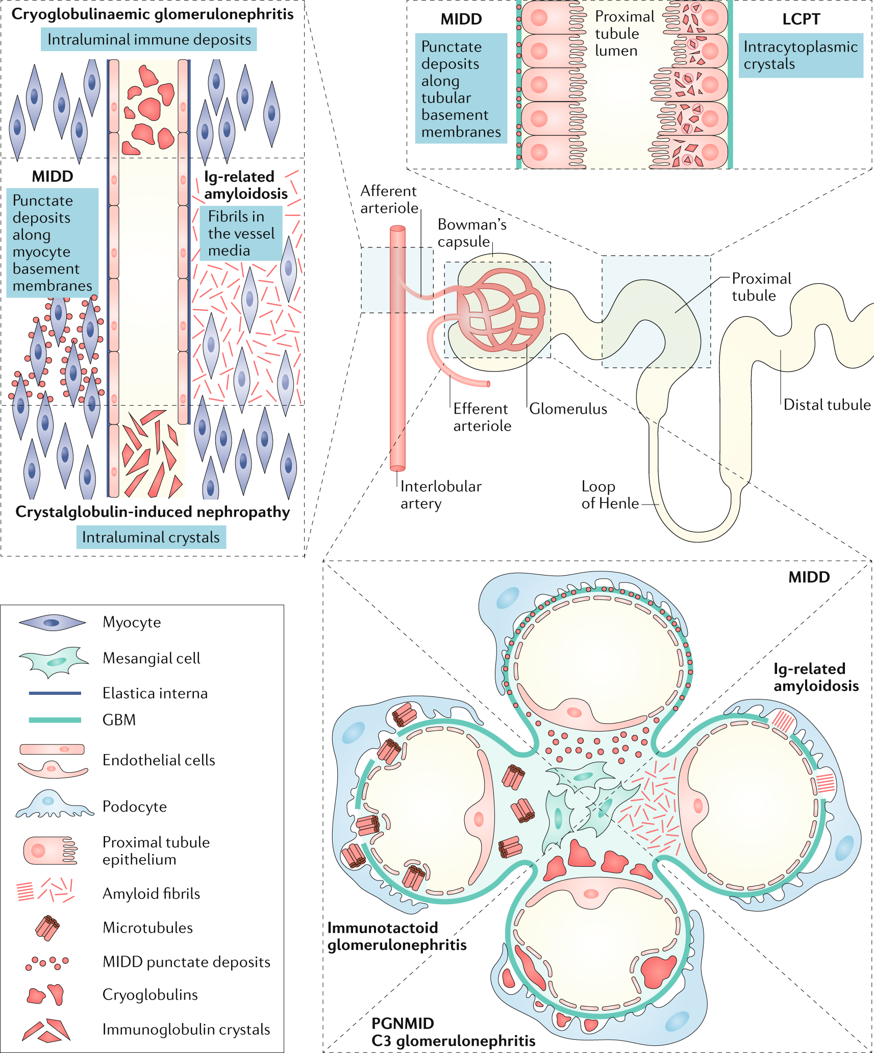 The evaluation of monoclonal gammopathy of renal significance: a consensus  report of the International Kidney and Monoclonal Gammopathy Research Group  | Nature Reviews Nephrology
