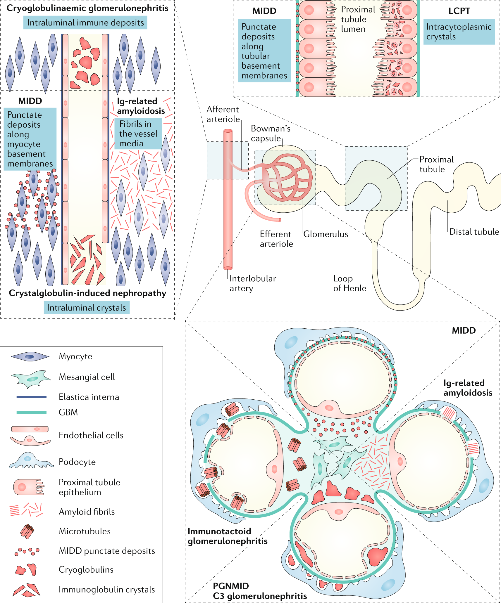 The Evaluation Of Monoclonal Gammopathy Of Renal Significance A Consensus Report Of The International Kidney And Monoclonal Gammopathy Research Group Nature Reviews Nephrology