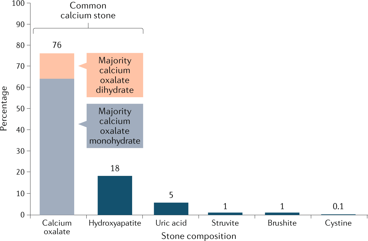 Kidney Stones: Emergency Department Diagnosis And Treatment