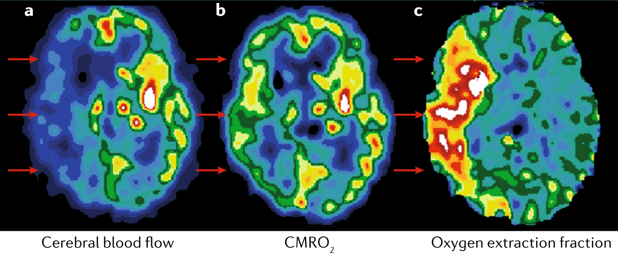 Mechanical Thrombectomy in Nighttime Hours: Is There a Difference