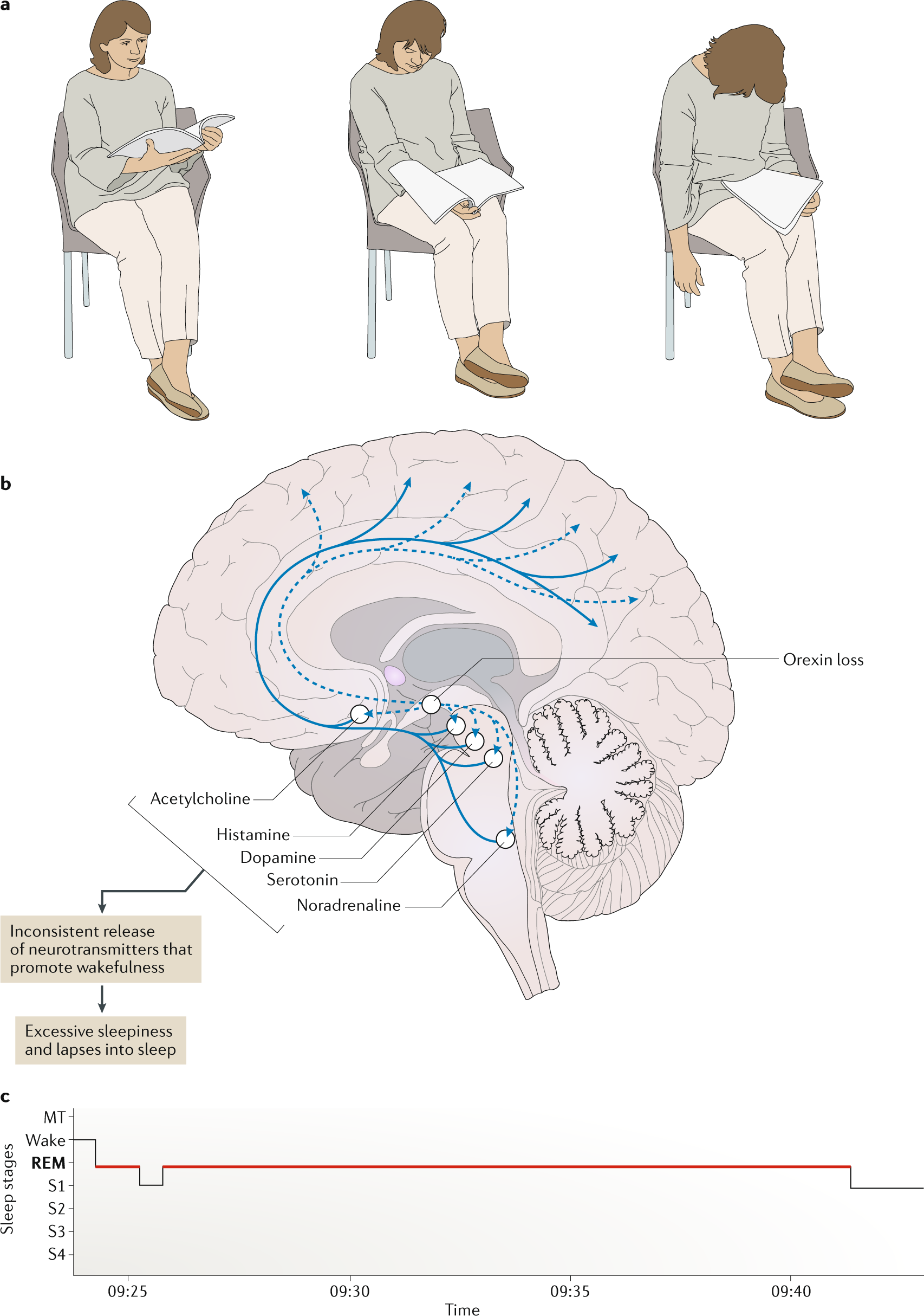 Narcolepsy — clinical spectrum, aetiopathophysiology, diagnosis and  treatment | Nature Reviews Neurology
