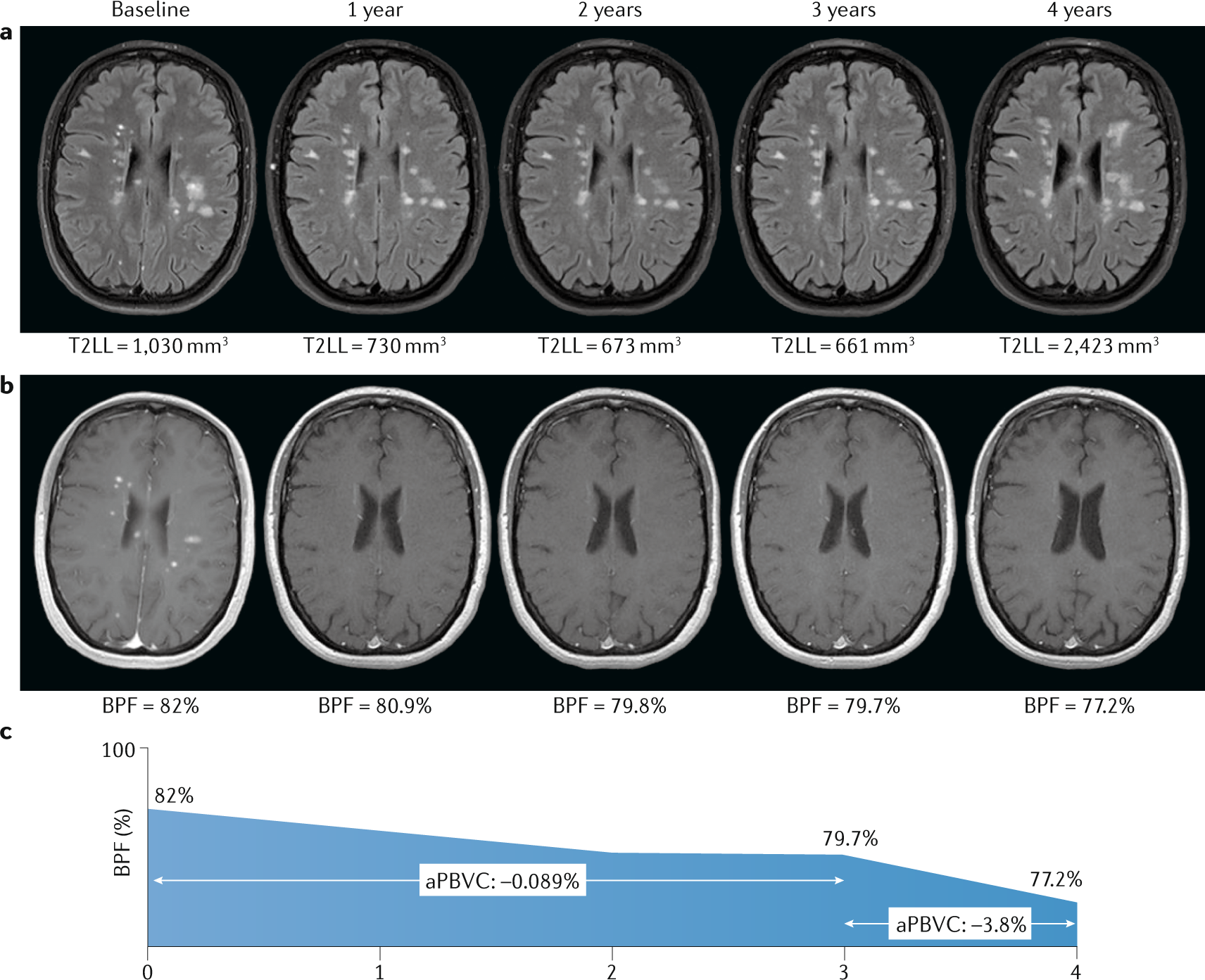 MAGNIMS consensus recommendations on the use of brain and spinal cord atrophy measures in clinical practice Nature Reviews Neurology