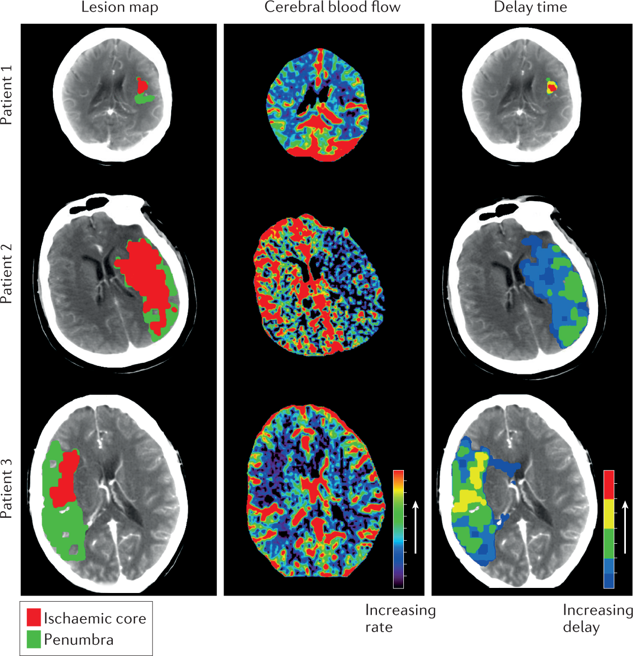 Artificial intelligence for decision support in acute stroke — current  roles and potential | Nature Reviews Neurology