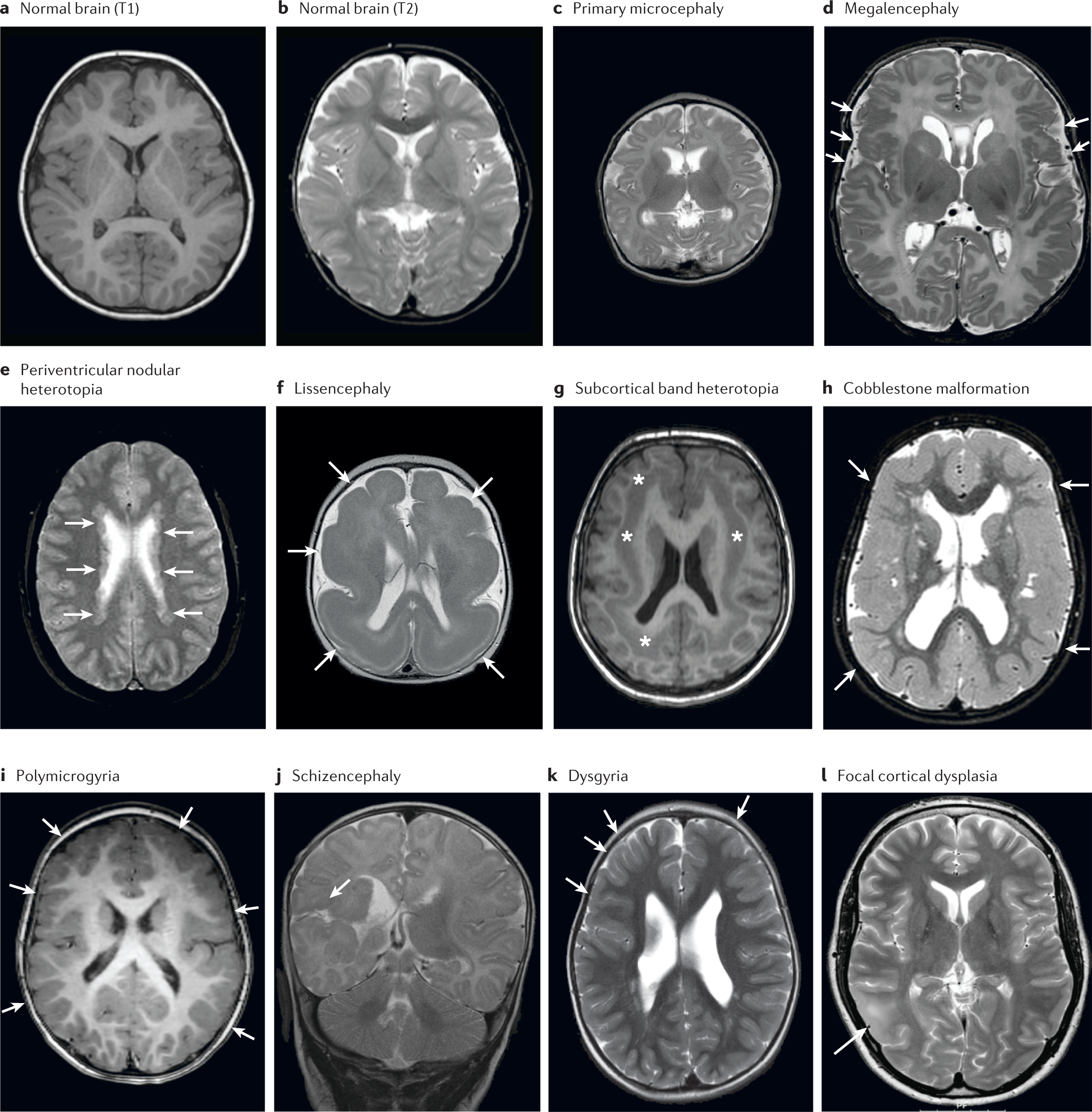 teknisk ifølge skillevæg International consensus recommendations on the diagnostic work-up for  malformations of cortical development | Nature Reviews Neurology