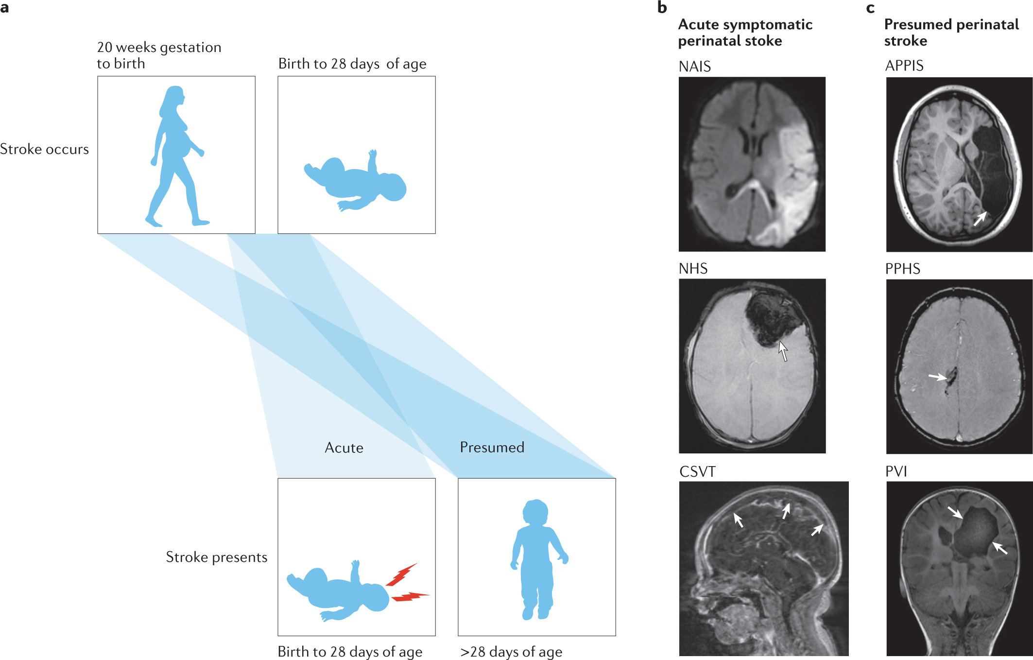 Perinatal stroke: mapping and modulating developmental plasticity | Nature  Reviews Neurology