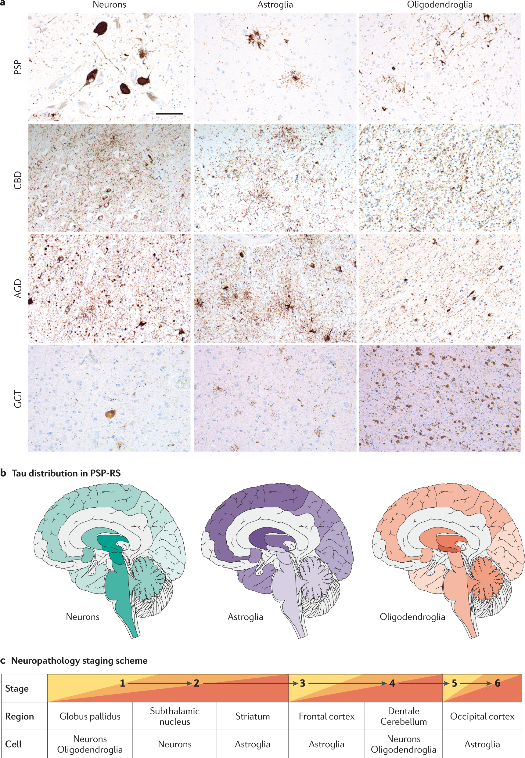 Evolving concepts in progressive supranuclear palsy and other 4-repeat  tauopathies | Nature Reviews Neurology