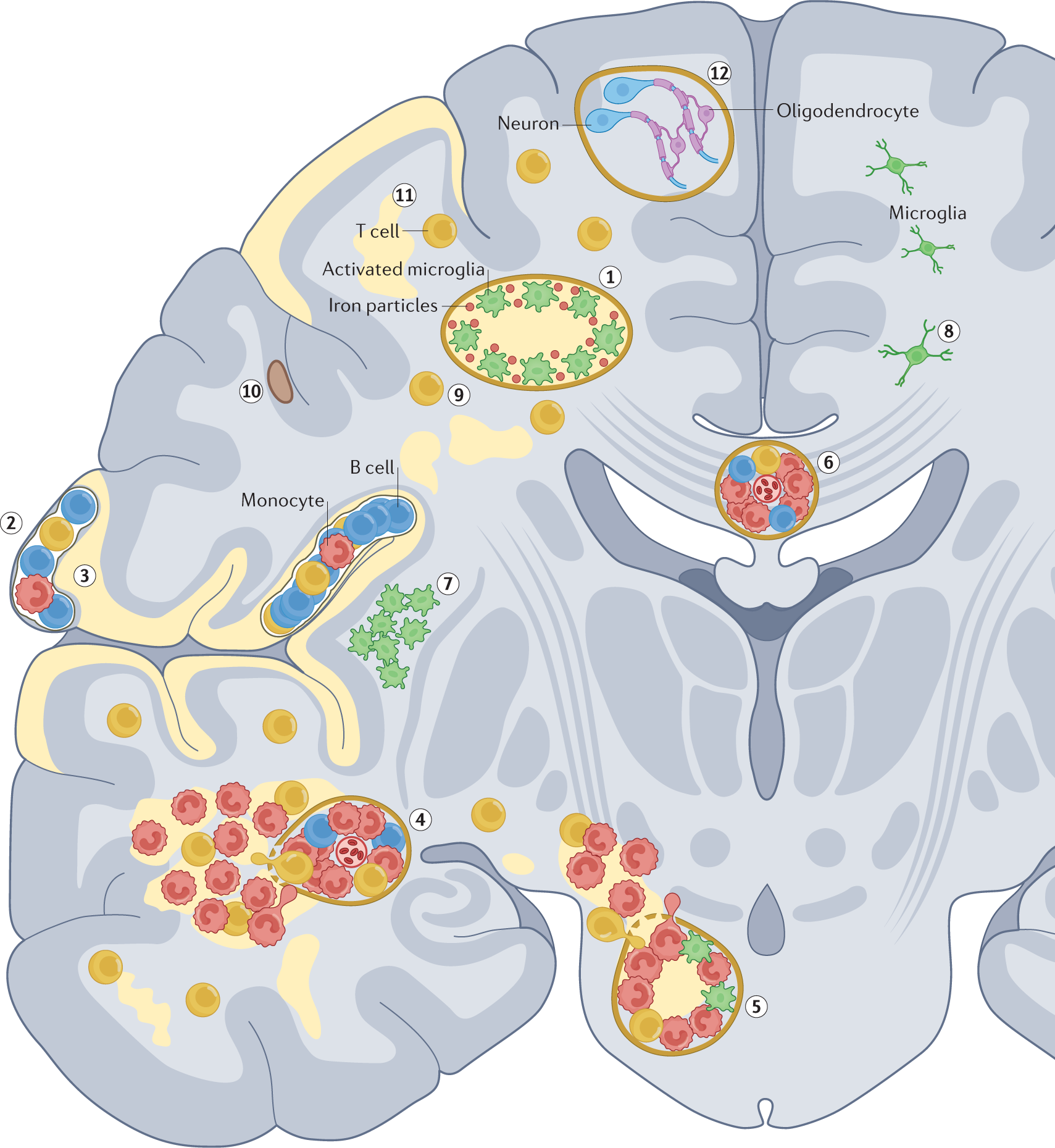 Mechanism Based Criteria To Improve Therapeutic Outcomes In Progressive Multiple Sclerosis Nature Reviews Neurology Mechanism Based Criteria To Improve Therapeutic Outcomes In Progressive Multiple Sclerosis Nature Reviews Neurology