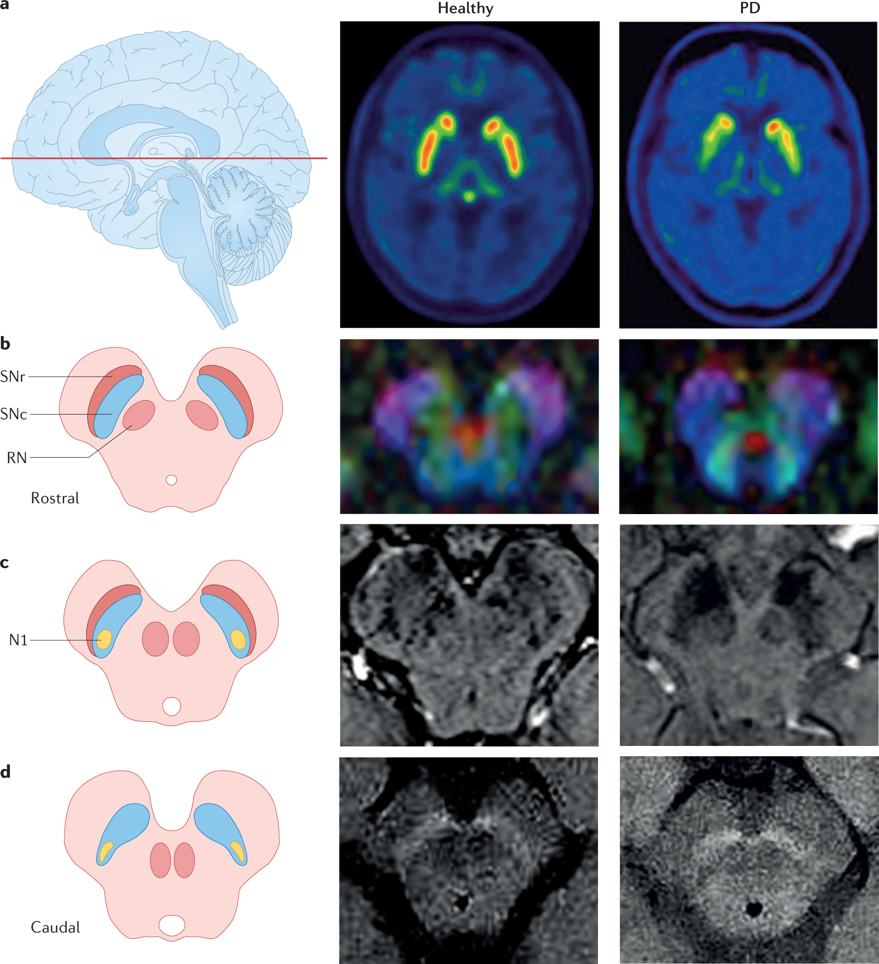 Orgullo Sangriento baño Multimodal brain and retinal imaging of dopaminergic degeneration in  Parkinson disease | Nature Reviews Neurology