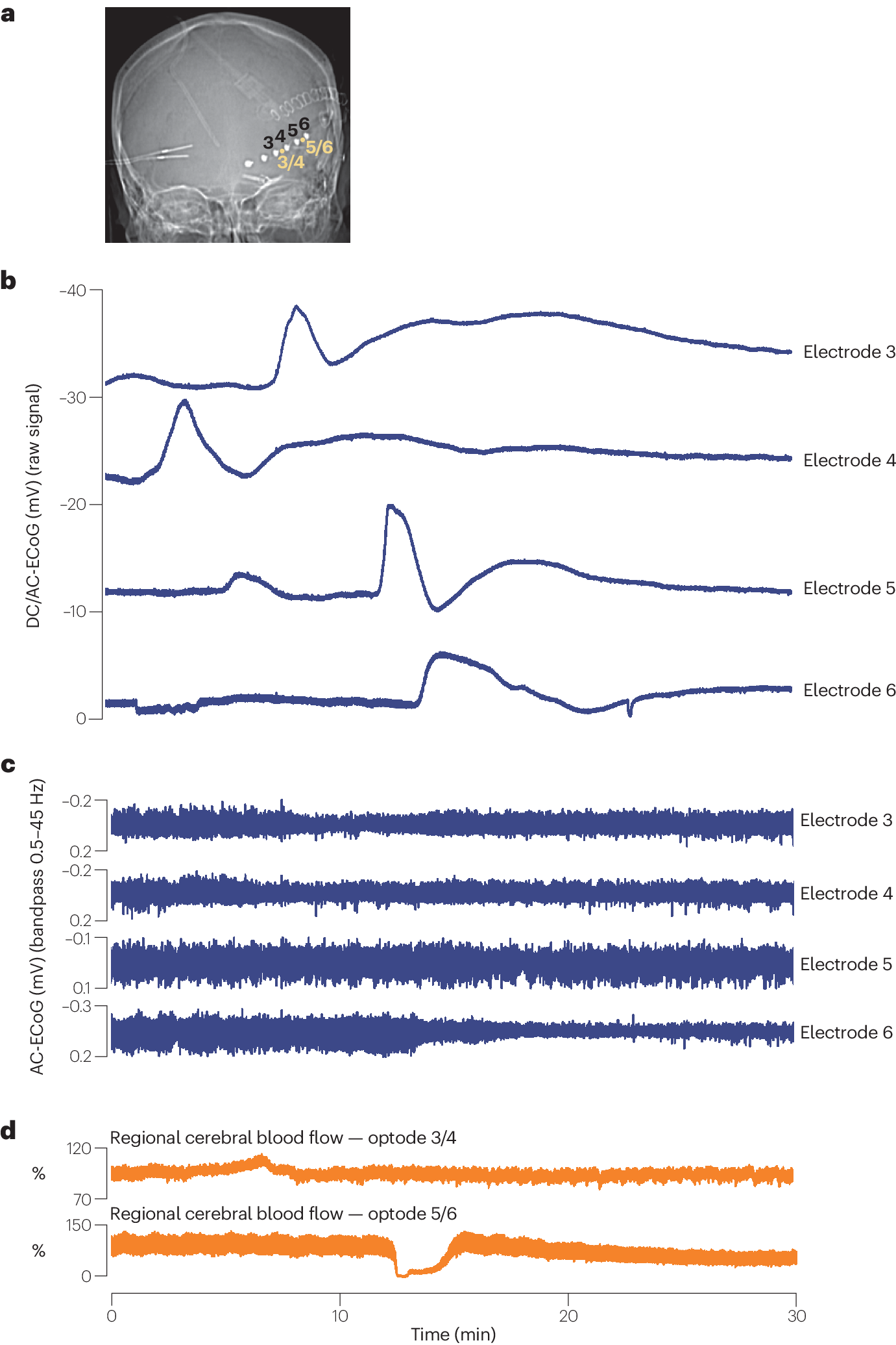 From spreading depolarization to blood–brain barrier dysfunction 