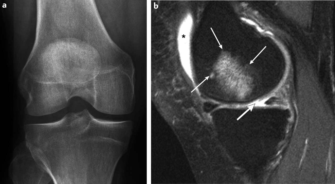The role of radiography and MRI for eligibility assessment in DMOAD trials  of knee OA | Nature Reviews Rheumatology