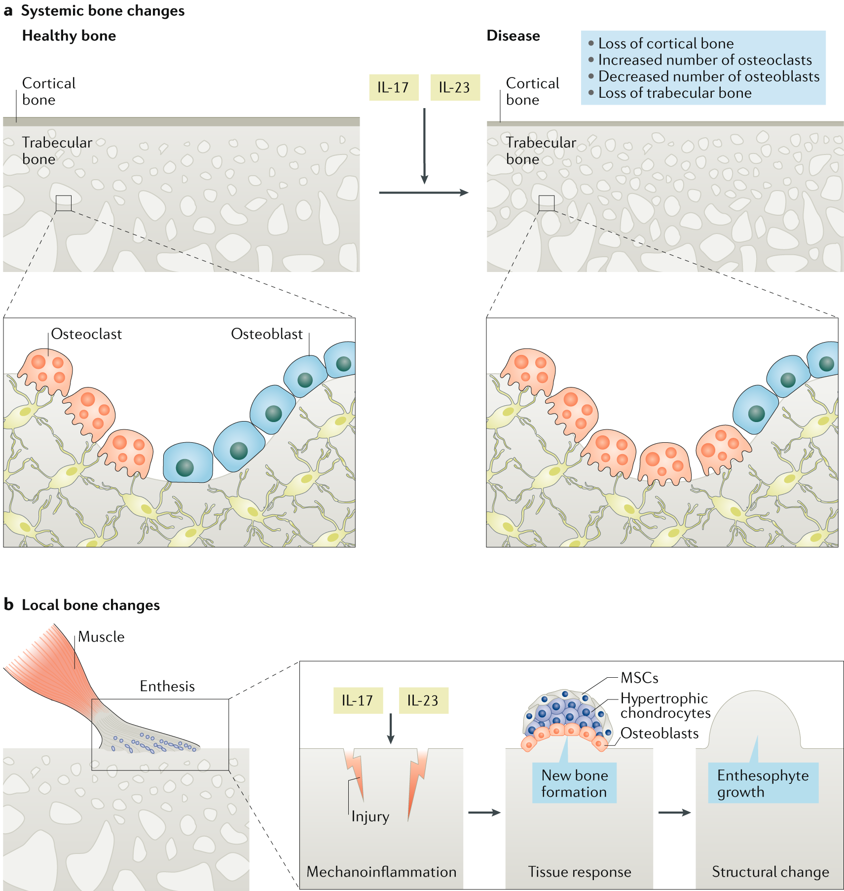 Effects Of The Il 23 Il 17 Pathway On Bone In Spondyloarthritis Nature Reviews Rheumatology