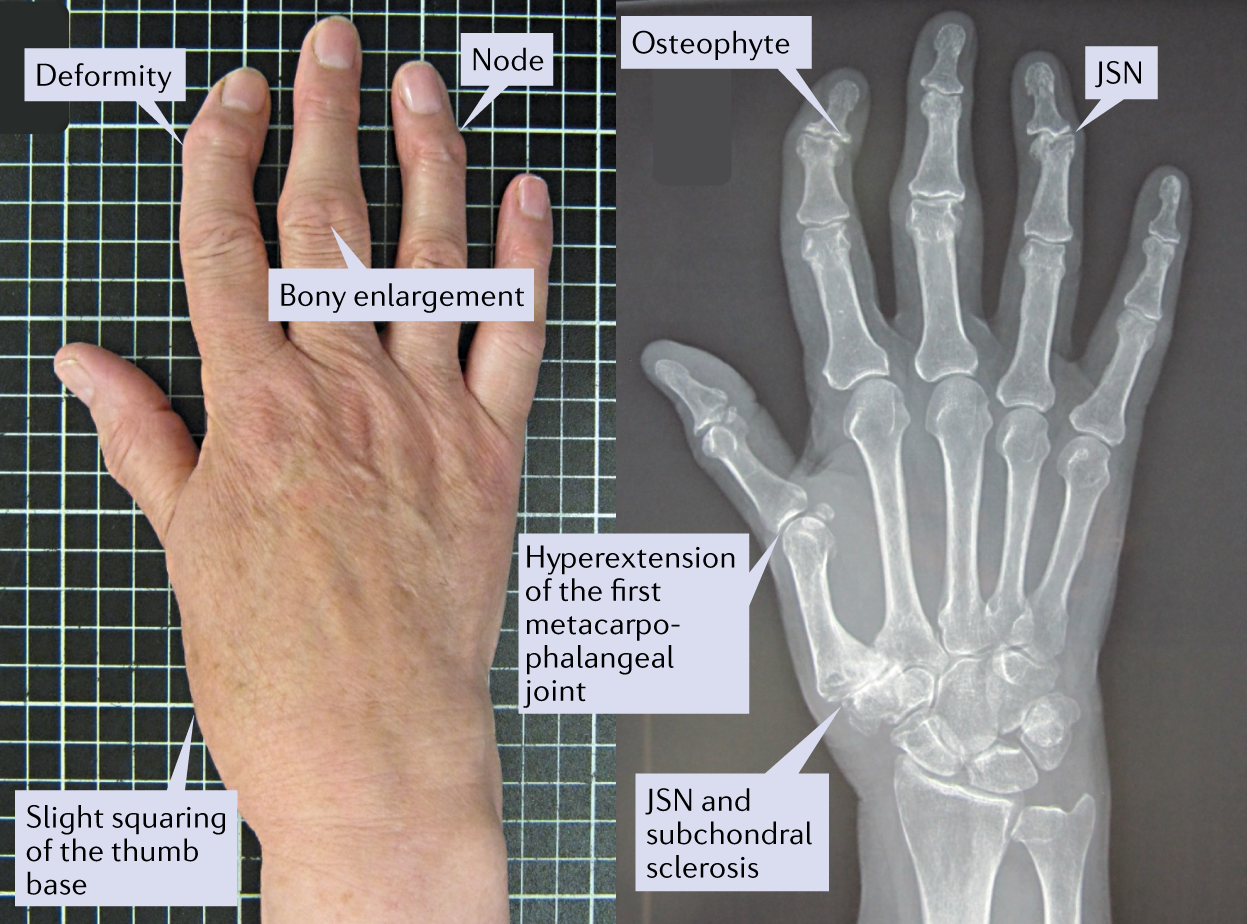 arthrose de la main