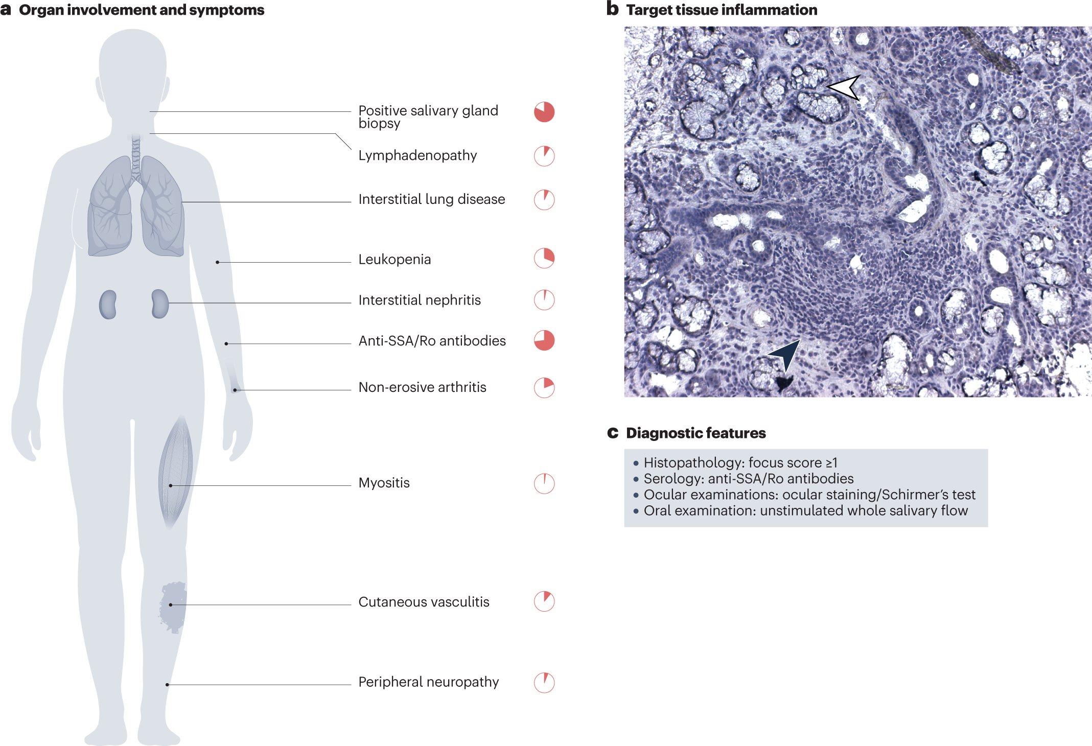 Genetics and epigenetics of primary Sjögren syndrome: implications for  future therapies | Nature Reviews Rheumatology
