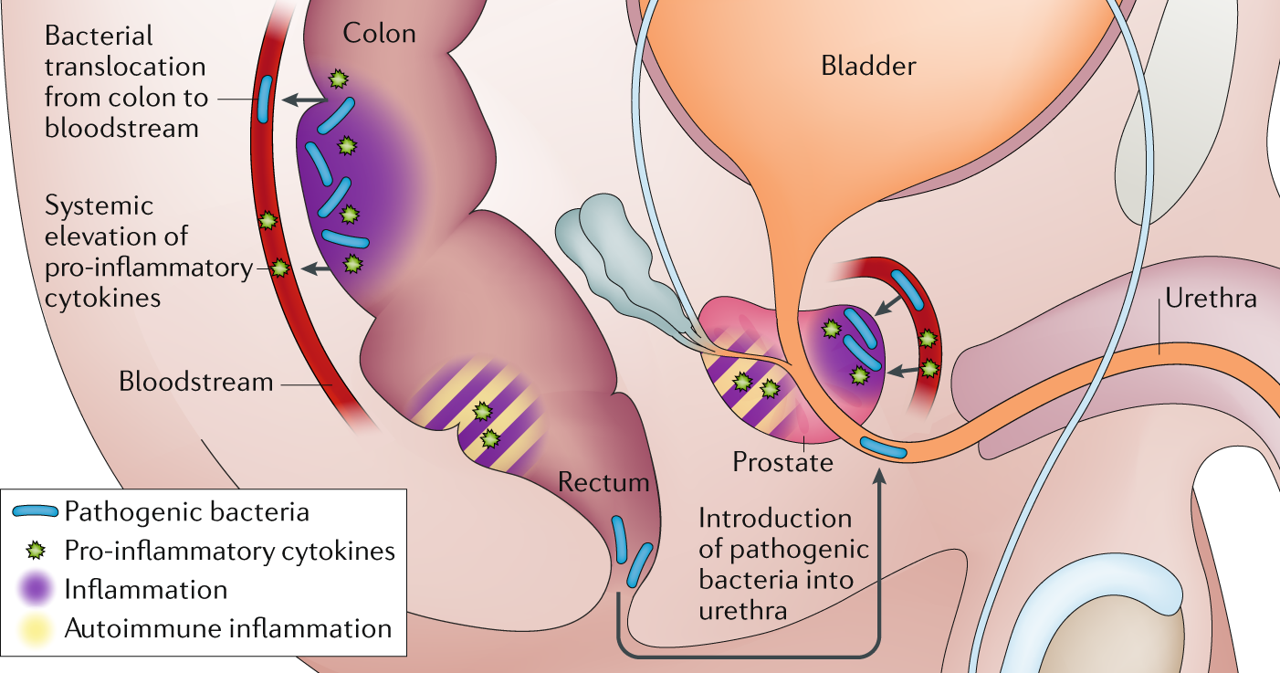 a prosztatagyulladás tünetei és kezelése a prostatitis- vélemények forrásai