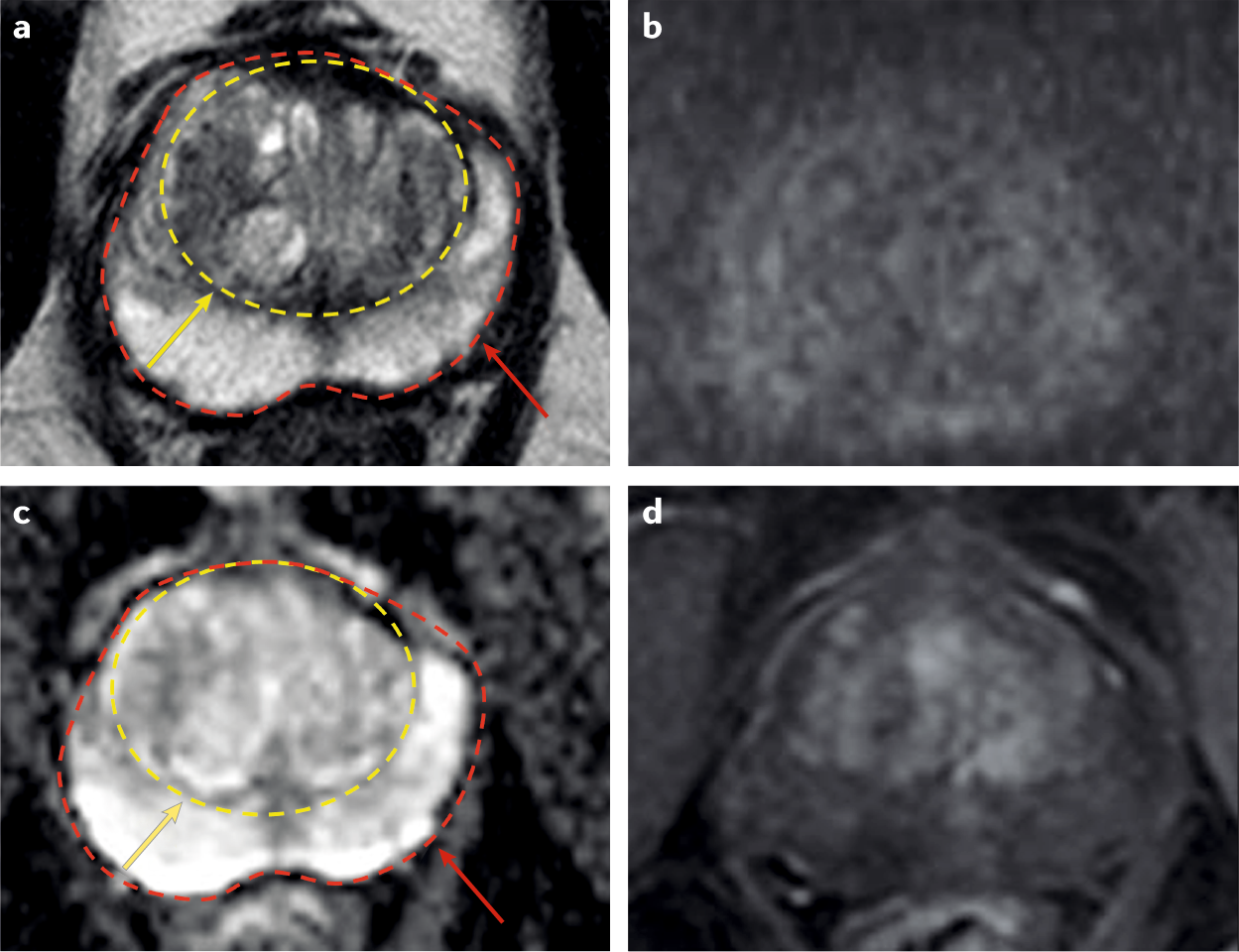 Prostate mri pitfalls radiology