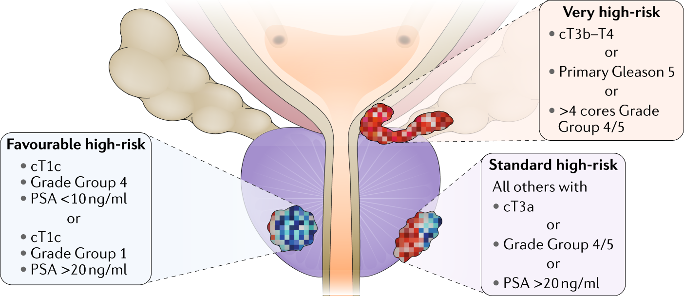 best treatment for high risk prostate cancer)