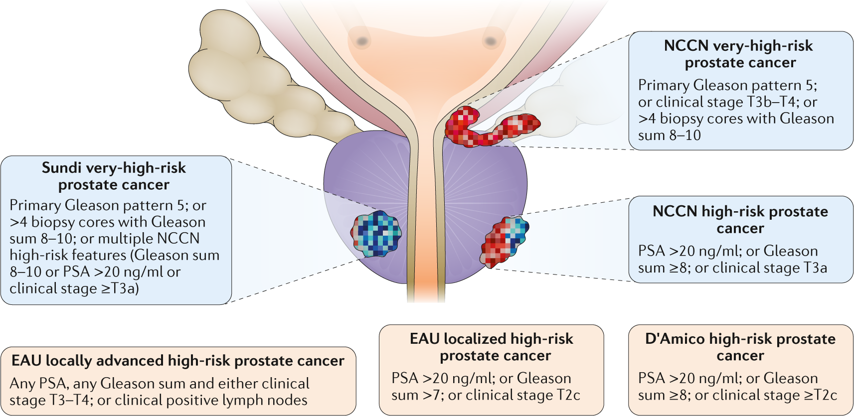 high volume prostate cancer definition)