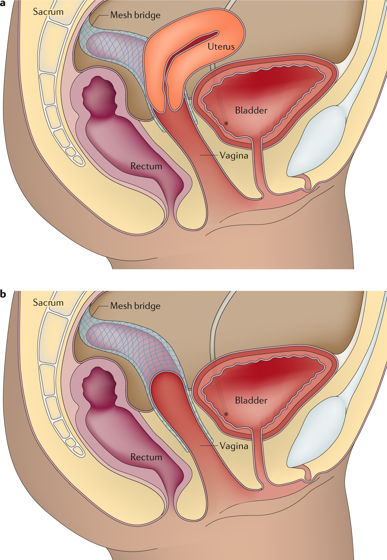 Pelvic organ prolapse and sexual function Nature Reviews Urology picture