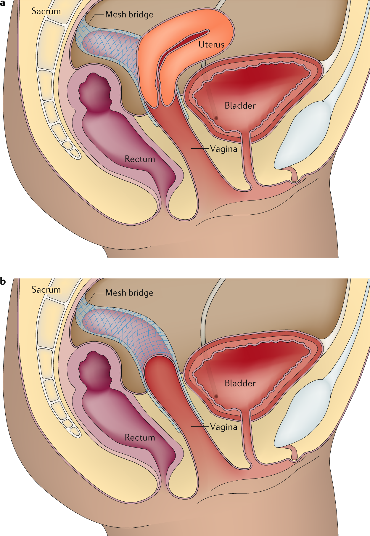 Can you have sex with a prolapsed uterus