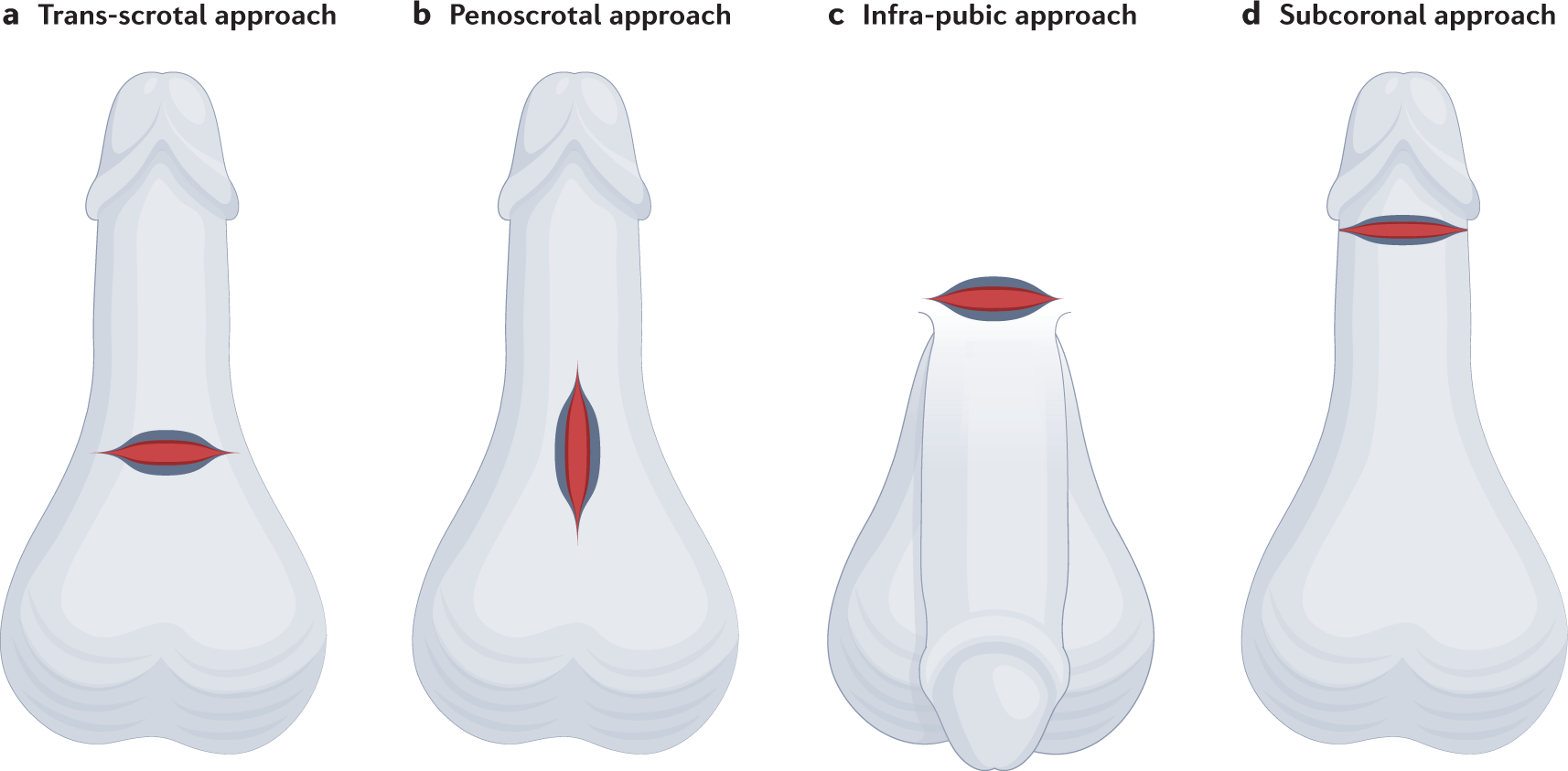 The International Penile Prosthesis Implant Consensus Forum clinical recommendations and surgical principles on the inflatable 3-piece penile prosthesis implant Nature Reviews Urology