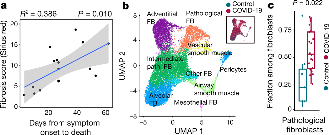 Fig. 4: Pathological fibroblasts and ensuing fibrosis in COVID-19.