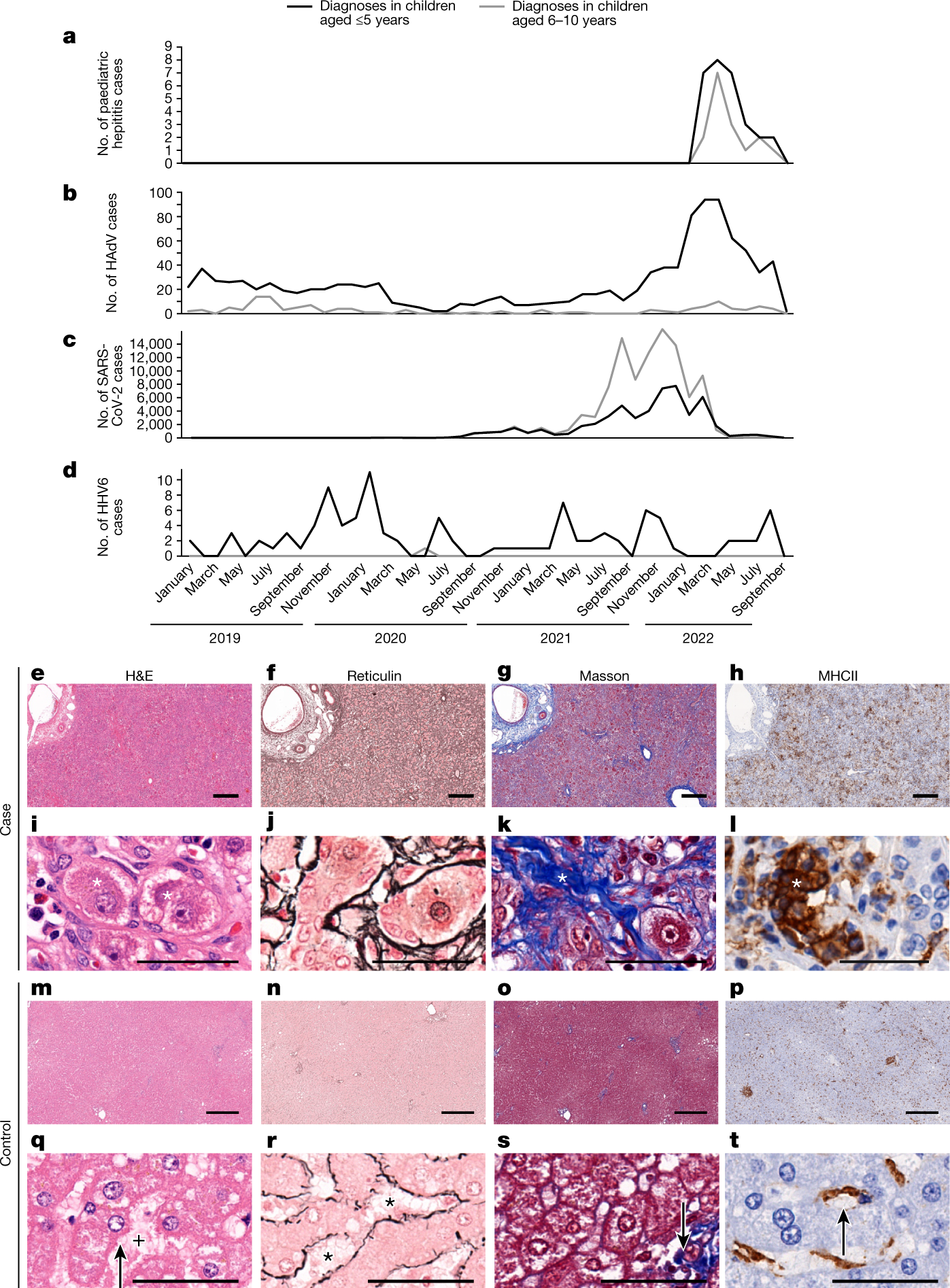 Adeno-associated virus 2 infection in children with non-A–E hepatitis