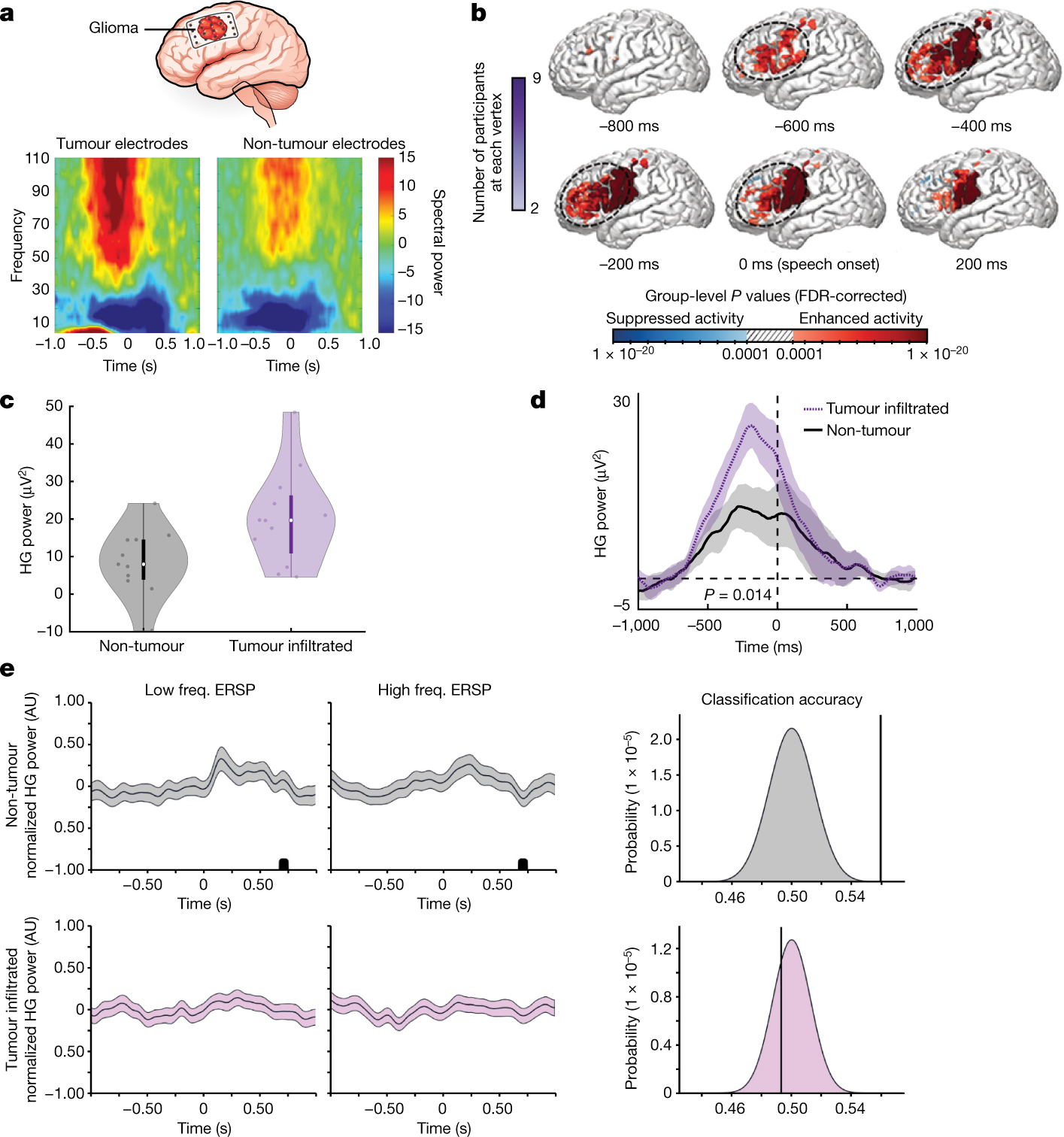 Glioblastoma remodelling of human neural circuits decreases survival Nature image pic