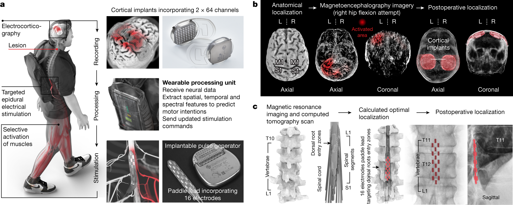 Walking naturally after spinal cord injury using a brain–spine interface