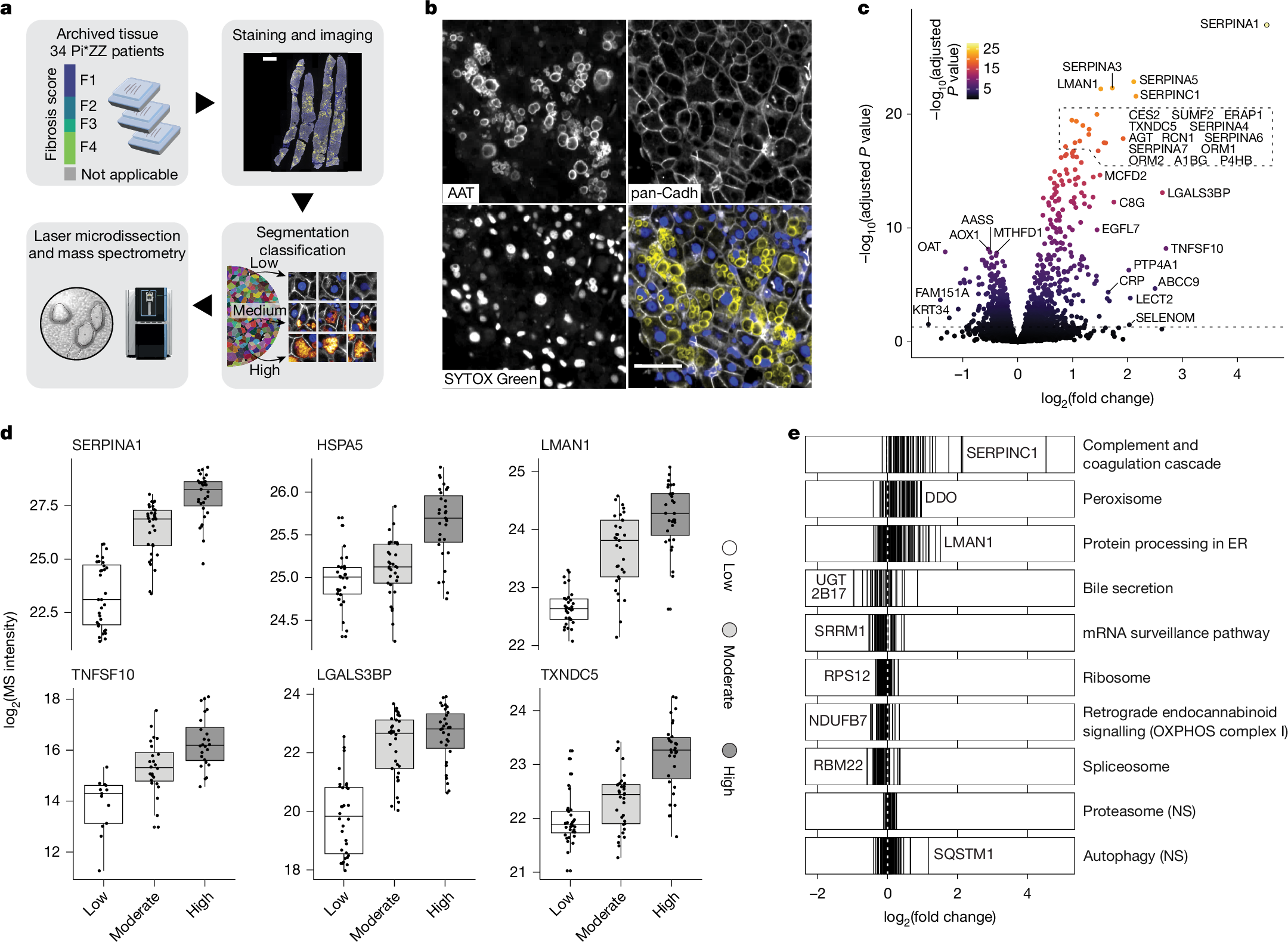 α1アンチトリプシン欠損症における健康な患者の保護要因を解明(Alpha-1 antitrypsin deficiency: What protects the one – and not the other?)
