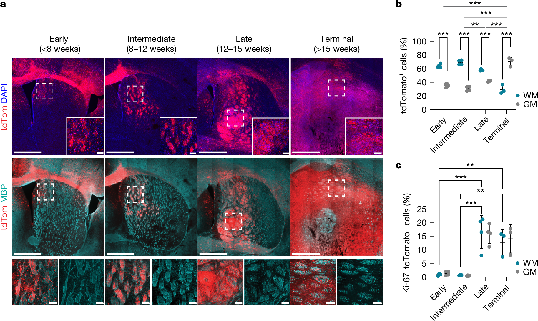 Axonal injury is a targetable driver of glioblastoma progression | Nature