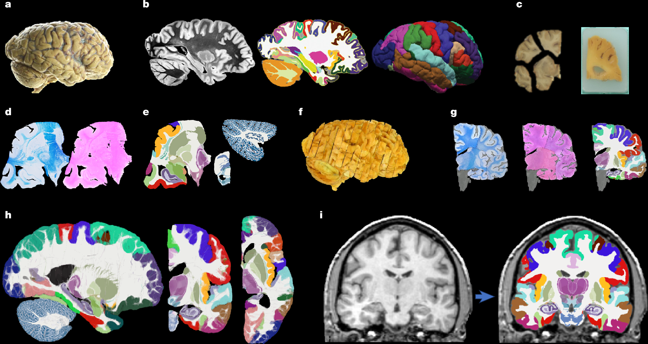 新たなMRI脳アトラスが前例のない詳細を提供(New brain atlas offers unprecedented detail in MRI scans)