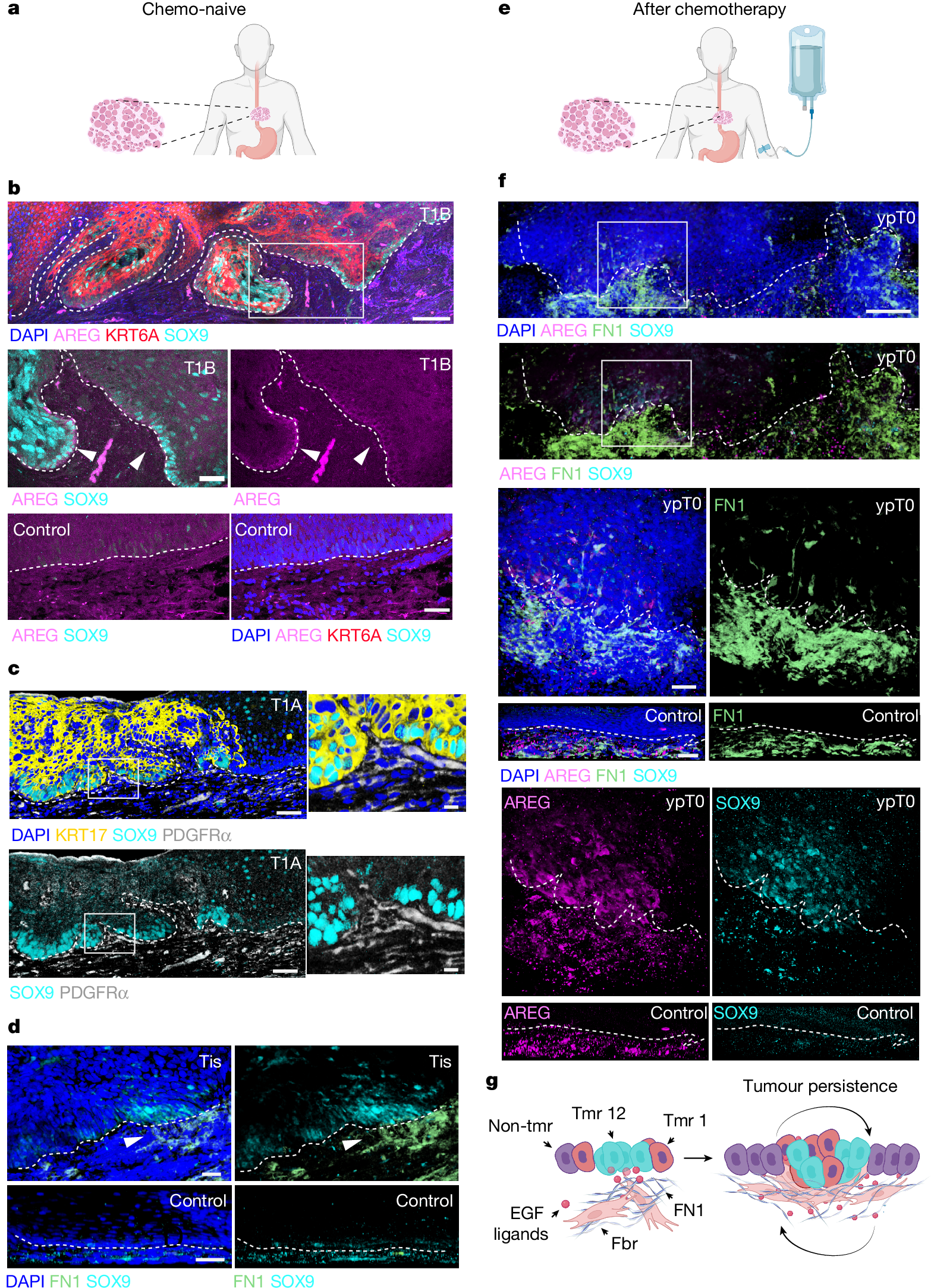 Fig. 5: Early tumour niche remodelling in human oesophageal squamous cell carcinoma.