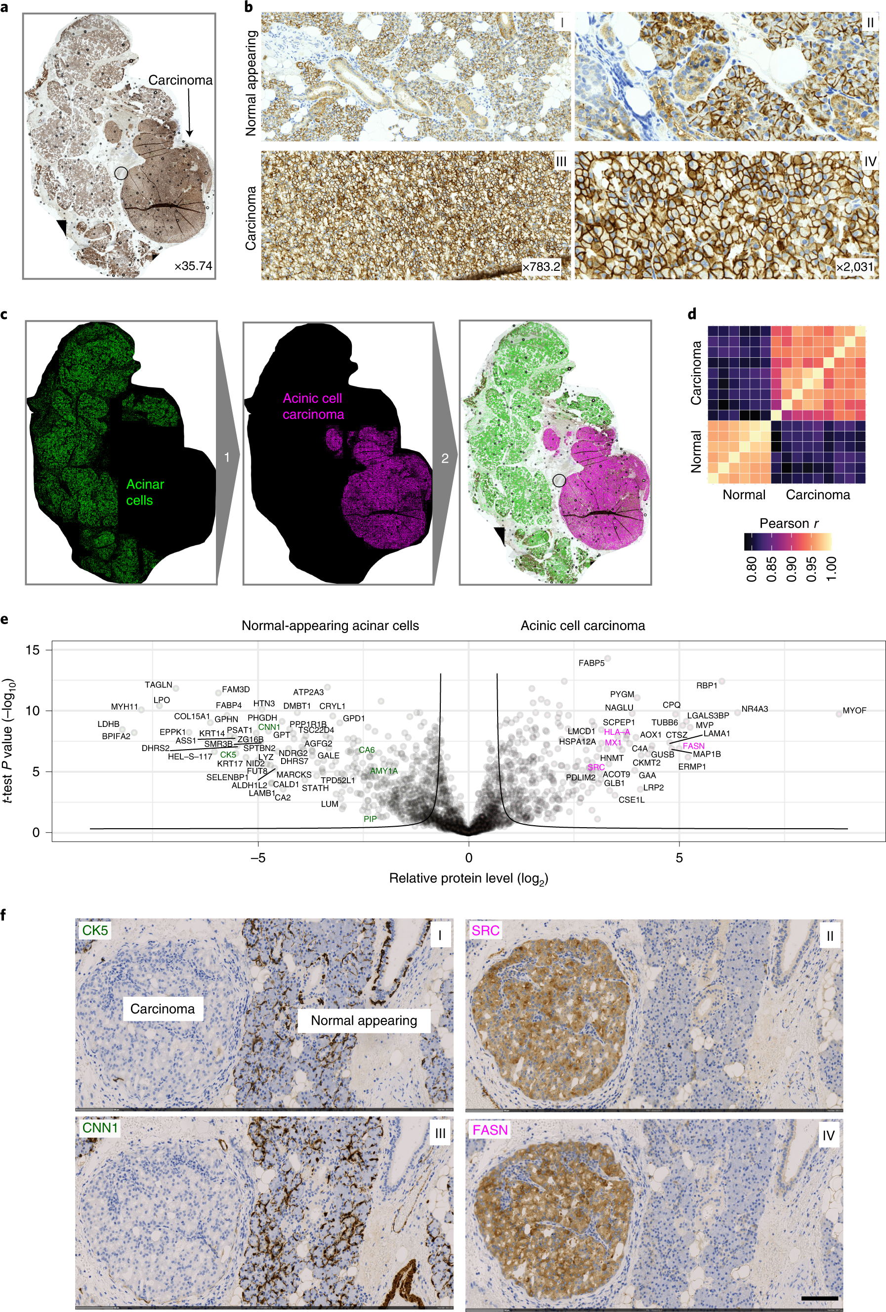 Fig. 4: DVP applied to archived tissue of a rare salivary gland carcinoma.