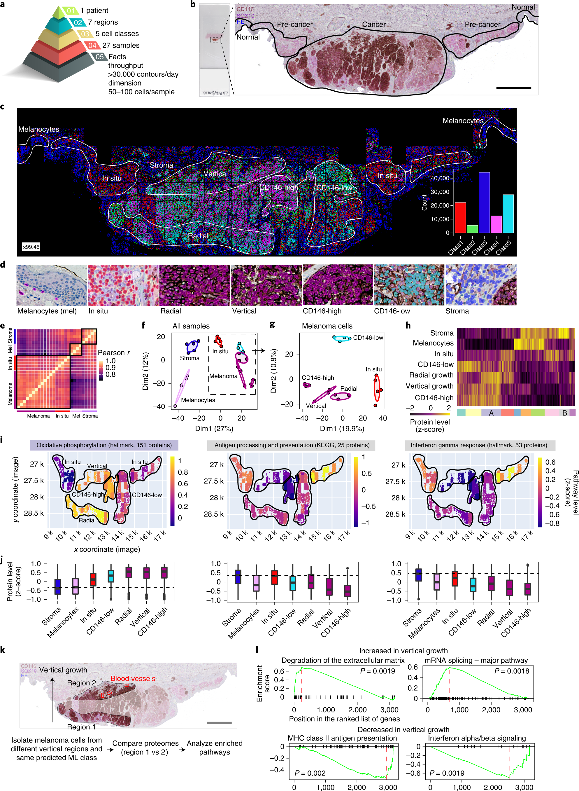 Fig. 5: DVP applied to archived primary melanoma tissue.
