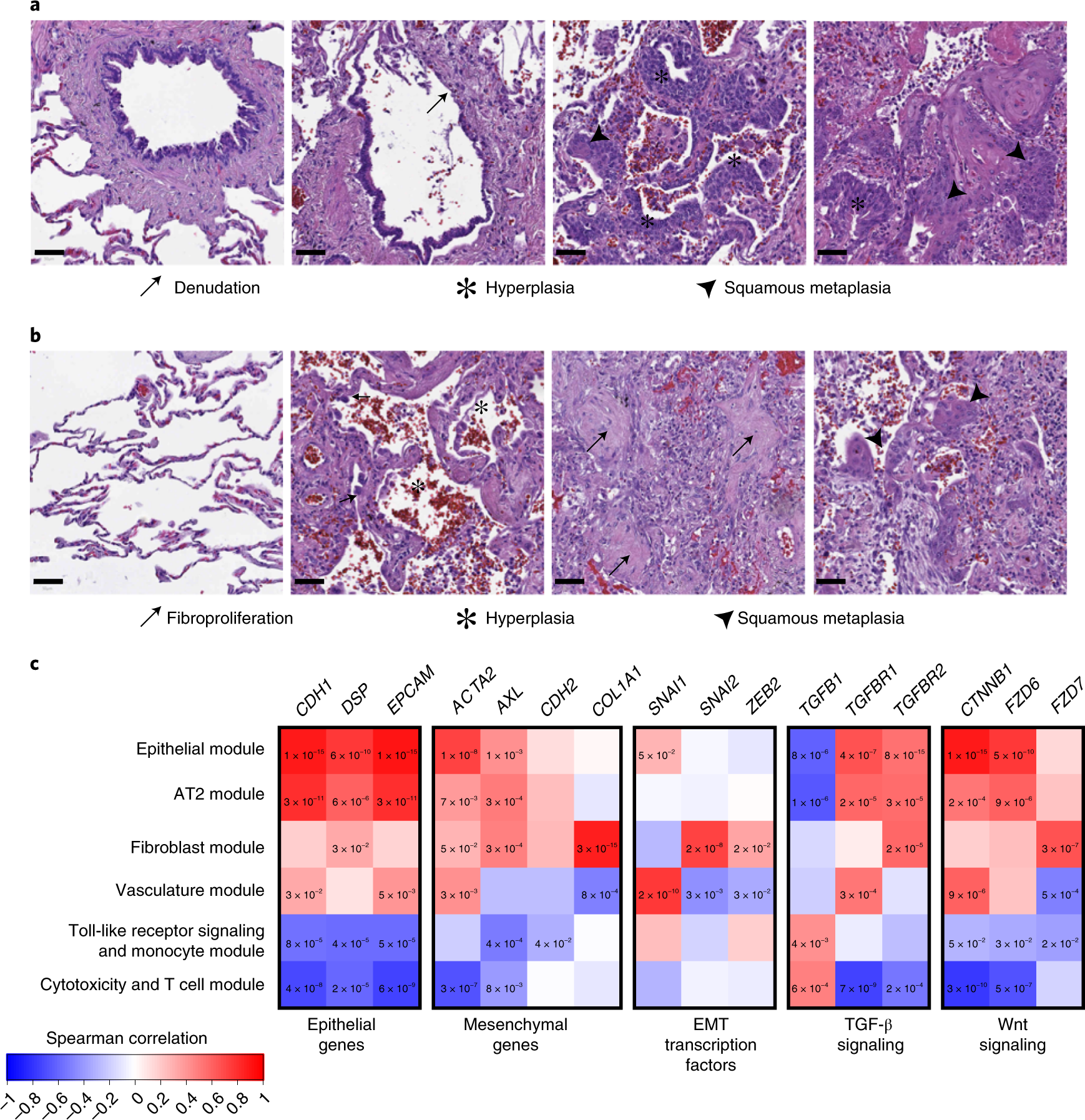 Fig. 5: The lungs of patients with COVID-19 show signals of EMT.