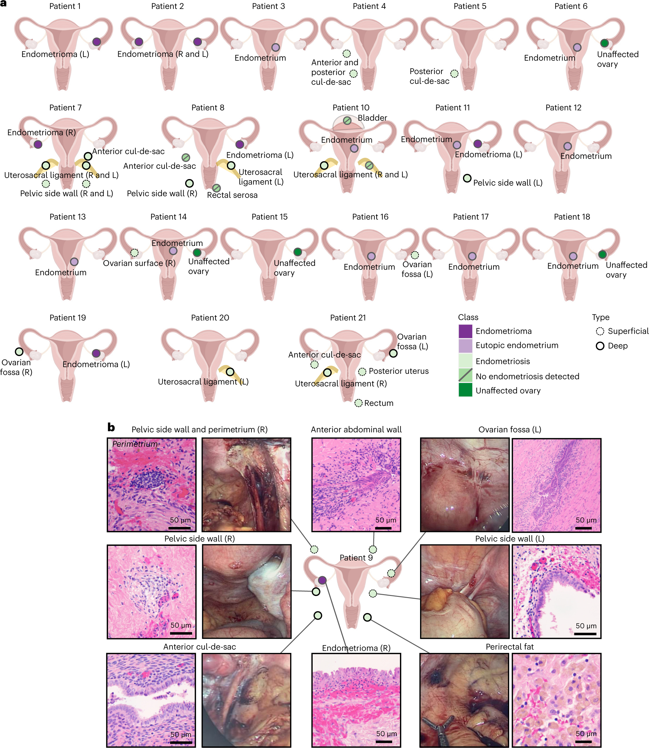 Hemorrhagic Ascites, Belly-Blood: The cause may be endometriosis!