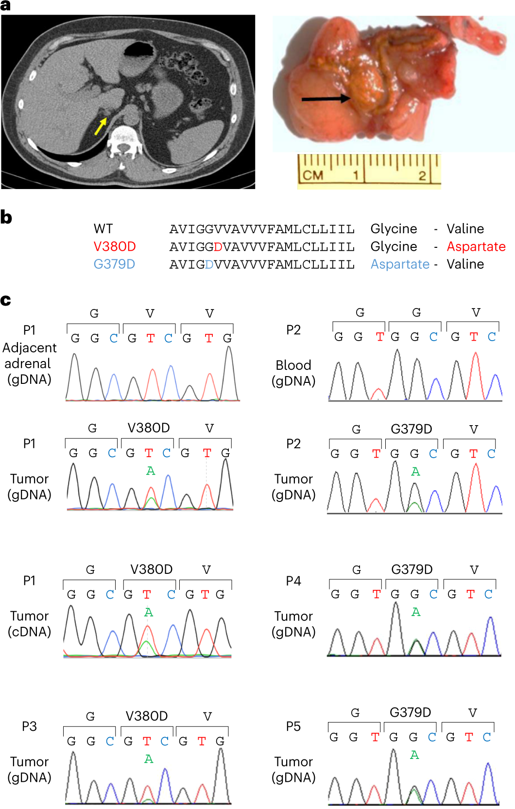Somatic mutations of CADM1 in aldosterone-producing adenomas and gap  junction-dependent regulation of aldosterone production | Nature Genetics