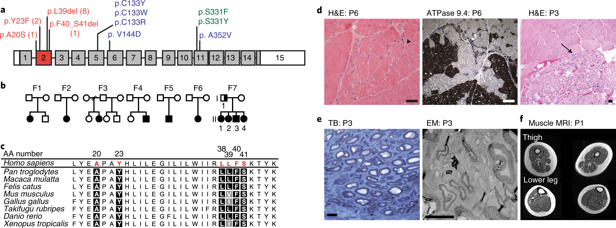 Betydelig Sæbe rysten Childhood amyotrophic lateral sclerosis caused by excess sphingolipid  synthesis | Nature Medicine