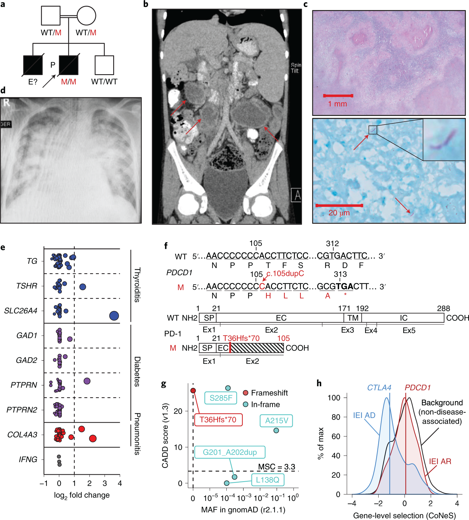 Inherited PD-1 deficiency underlies tuberculosis and autoimmunity in a  child | Nature Medicine