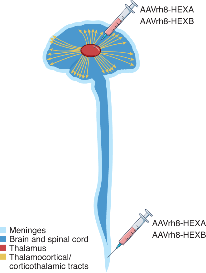 Tay-Sachs Disease: Signs and Symptoms