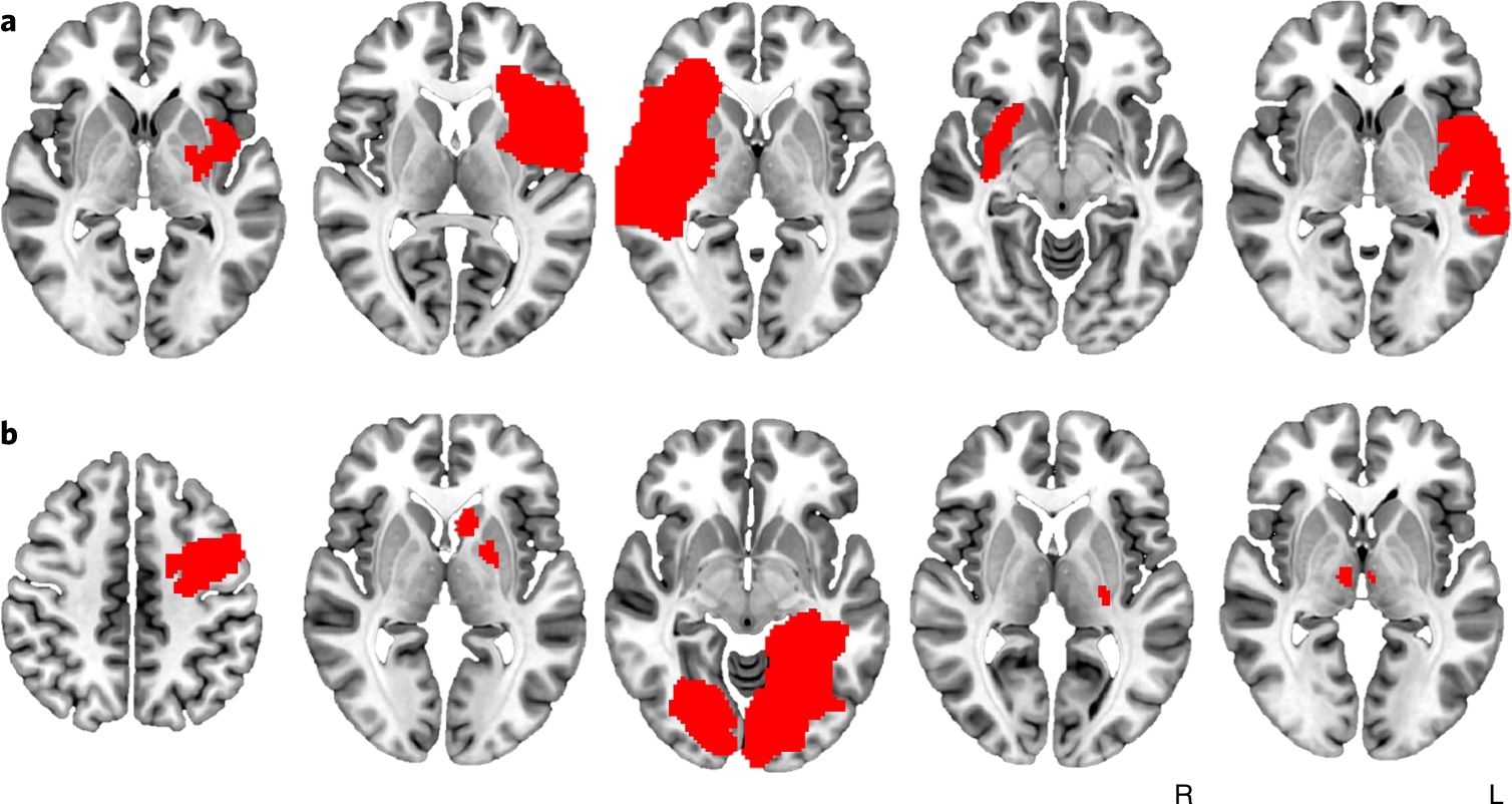 Brain lesions disrupting addiction map to a common human brain