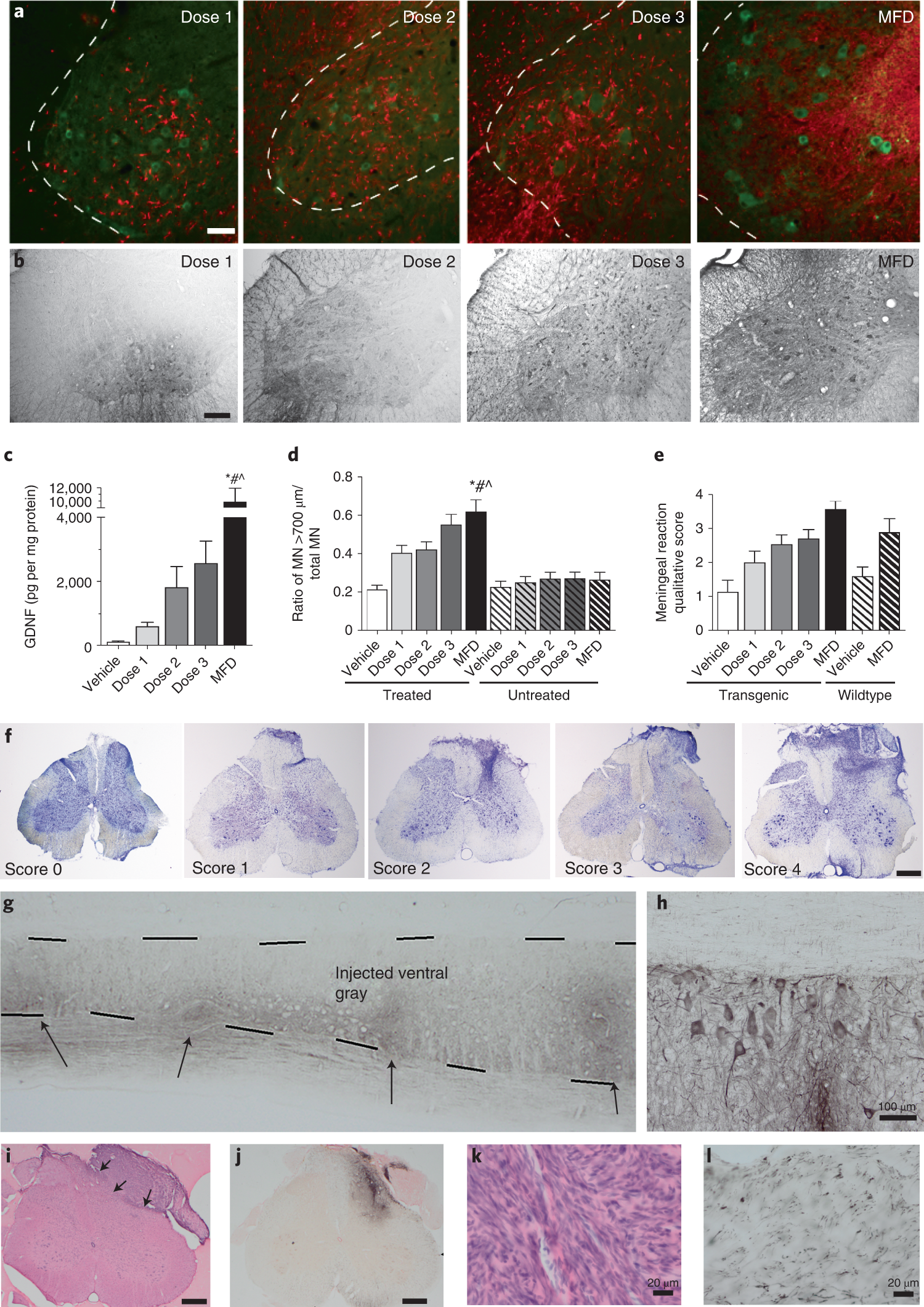 Transplantation of human neural progenitor cells secreting GDNF into the  spinal cord of patients with ALS: a phase 12a trial | Nature Medicine
