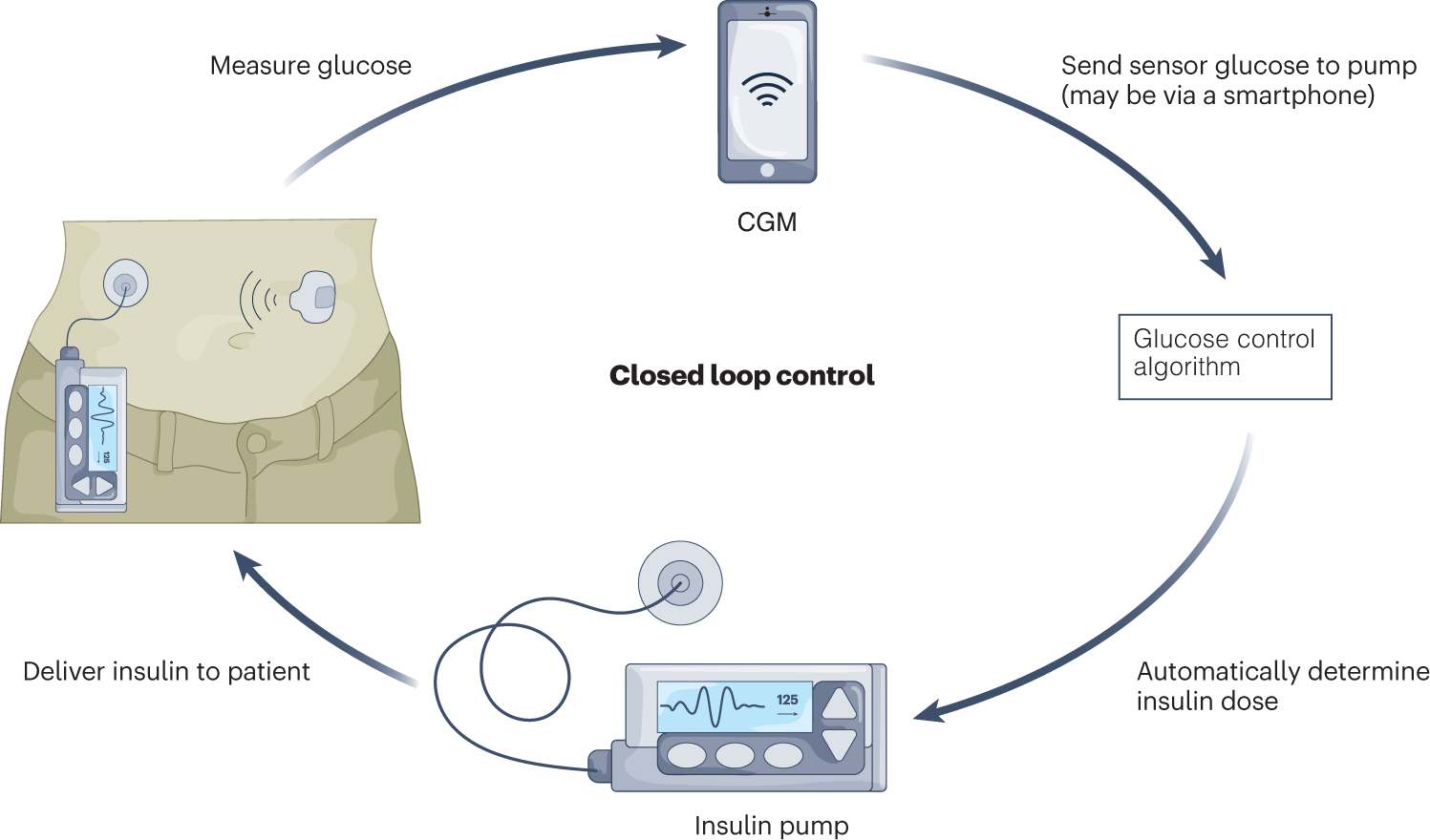 Closing in on closed-loop systems for type 2 diabetes
