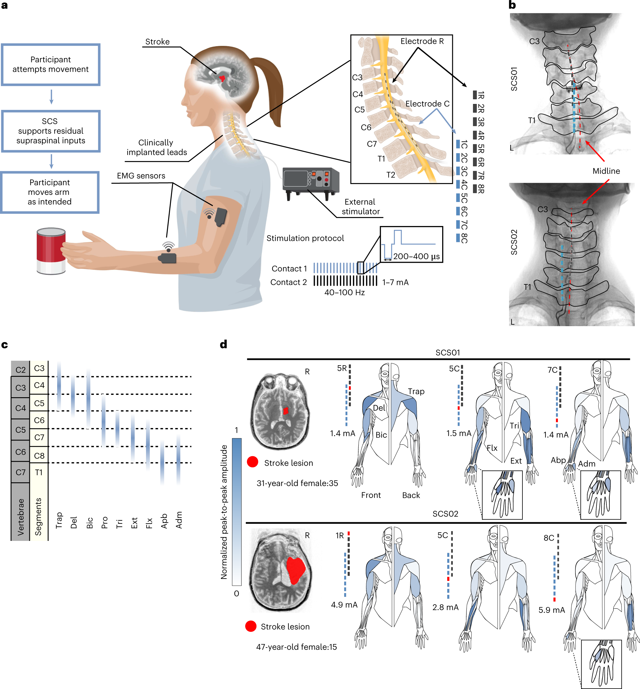 How Does a Spinal Cord Stimulator Trial Work?: Kellogg Brain and Spine:  Spinal Disorders